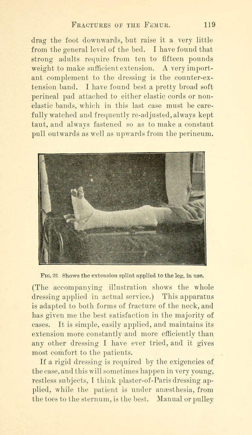 drag the foot downwards, but raise it a very little from the general level of the bed. I have found that strong adults require from ten to fifteen pounds weight to make sufficient extension. A very import- ant complement to the dressing is the counter-ex- tension band. I have found best a pretty broad soft perineal pad attached to either elastic cords or non- elastic bands, which in this last case must be care- fully watched and frequently re-adjusted, always kept taut, and always fastened so as to make a constaut pull outwards as well as upwards from the perineum. Fig. S3. Shows the extension splint applied to the leg, in use. (The accompanying illustration shows the whole dressing applied in actual service.) This apparatus is adapted to both forms of fracture of the neck, and has given me the best satisfaction in the majority of cases. It is simple, easily applied, and maintains its extension more constantly and more efficiently than any other dressing I have ever tried, and it gives most comfort to the patients. If a rigid dressing is required by the exigencies of the case, and this will sometimes happen in very young, restless subjects, I think plaster-of-Paris dressing ap- plied, while the patient is under anaesthesia, from the toes to the sternum, is the best, Manual or pulley