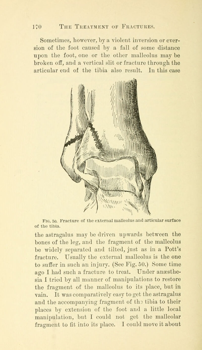 Sometimes, however, by a violent inversion or ever- sion of the foot caused by a fall of some distance upon the foot, one or the other malleolus may be broken off, and a vertical slit or fracture through the articular end of the tibia also result. In this case Fig. 50. Fracture of the external malleolus and articular surface of the tibia. the astragalus may be driven upwards between the bones of the leg, and the fragment of the malleolus be widely separated and tilted, just as in a Pott's fracture. Usually the external malleolus is the one to suffer in such an injury. (See Fig. 50.) Some time ago I had such a fracture to treat. Under anaesthe- sia I tried by all manner of manipulations to restore the fragment of the malleolus to its place, but in vain. It was comparatively easy to get the astragalus and the accompanying fragment of tli3 tibia to their places by extension of the foot and a little local manipulation, but I could not get the malleolar fragment to fit into its place. I could move it about