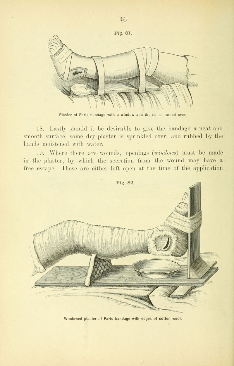 Plaster of Paris bandage with a window ana the edges iurned over. 18. Lastly should it be desirable to give the bandage a neat and smooth surface, some dry plaster is sprinkled over, and rubbed by the hands moistened with water. 19. Where there are wounds, openings (windows) must be made in the plaster, by which the secretion from the wound may have a free escape. These are either left open at the time of the application Fig. 82. Windowed plaster of Paris bandage with edges of cotton wool.