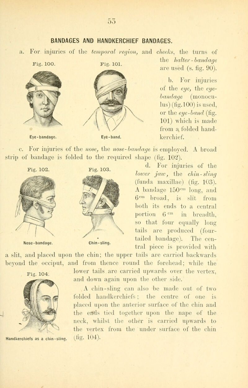 .),) BANDAGES AND HANDKERCHIEF BANDAGES. a. For injuries of the temporal region, and cheeks, the turns of the halter-bandage Fig. 100. Fig. 101. Eye-bandage. Eye-band. are used (s. fig. 90). I). For injuries of the eye, the eye- bandage (monocu- lus)(fig.lOO)isused, or the eye-band (tig. 101) whieh is made from a folded hand- kerchief. c. For injuries of the nose, the nose-bandage is employed. A broad strip of bandage is folded to the required shape (fig. 102). d. For injuries of the Fig. 102. Fig. 103. Chin-sling. lower jaw, the chin-sling (funda maxillae) (fig. 103). A bandage 150cm long, and 6cm broad, is slit from both its ends to a central portion 6cm in breadth, so that four equally long tails are produced (four- tailed bandage). The cen- tral piece is provided with a slit, and placed upon the chin; the upper tails are carried backwards beyond the occiput, and from thence round the forehead; while the lower tails are carried upwards over the vertex, and down again upon the other side. A chin-sling can also be made out of two folded handkerchiefs; the centre of one is placed upon the anterior surface of the chin and the ends tied together upon the nape of the neck, whilst the other is carried upwards to ^ the vertex from the under surface of the chin Handkerchiefs as a chin-sling. I,tig. 104). Nose-bandage. Fig. 104.