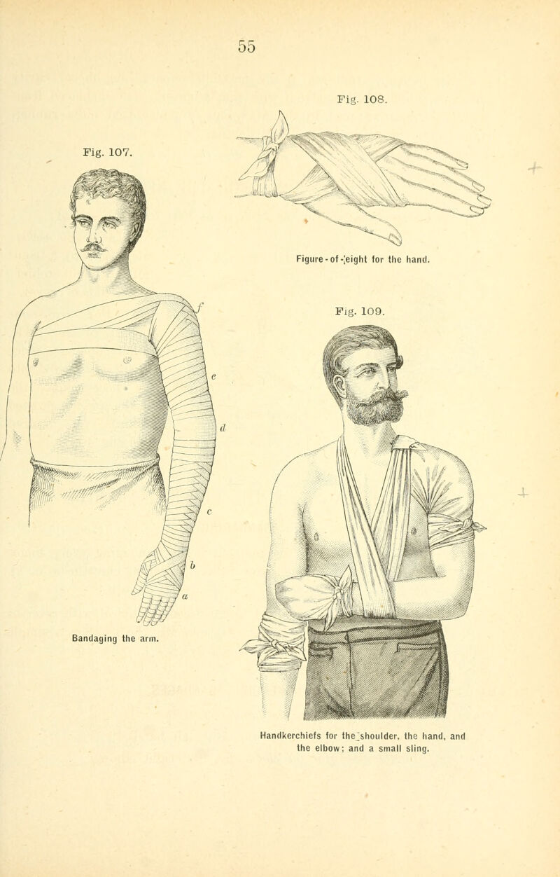 Fig. 108. Fig. 107 Bandaging the arm -4- Handkerchiefs for thejshoulder, the hand, and the elbow: and a small sling.