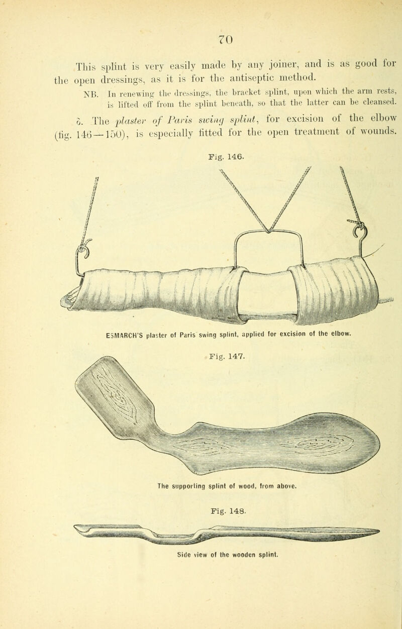 This splint is very easily made by any joiner, and is as good for the open dressings, as it is for the antiseptic method. NB. In renewing- the dressings, the bracket splint, upon which the arm rests, is lifted off from the splint beneath, so that the latter can be cleansed. 5. The plaster of Paris swing splint, for excision of the elbow (fig. 146—150), is especially fitted for the open treatment of wounds. Fig. 146. ESMARCH'S plaster of Paris swing splint, applied for excision of the elbov Fie. 147. The supporting splint of wood, from above. Fig. 148. Side view of the wooden splint.