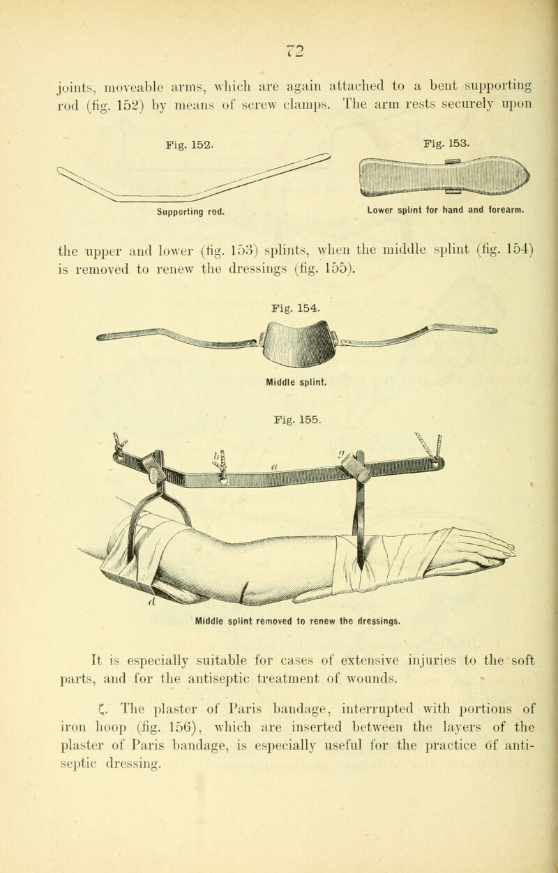 CZ joints, moveable arms, which are again attached to a bent supporting rod (fig. 152) by means of screw clamps. The arm rests securely upon Fig. 152. Fig. 153. Supporting rod. Lower splint for hand and forearm. the upper and lower (fig. 153) splints, when the middle splint (fig. 154) is removed to renew the dressings (fig. 155). Middle splint. Fig. 155. Middle splint removed to renew the dressings. It is especially suitable for cases of extensive injuries to the soft parts, and for the antiseptic treatment of wounds. C- The plaster of Paris bandage, interrupted with portions of iron hoop (fig. 156), which are inserted between the layers of the plaster of Paris bandage, is especially useful for the practice of anti- septic dressing.