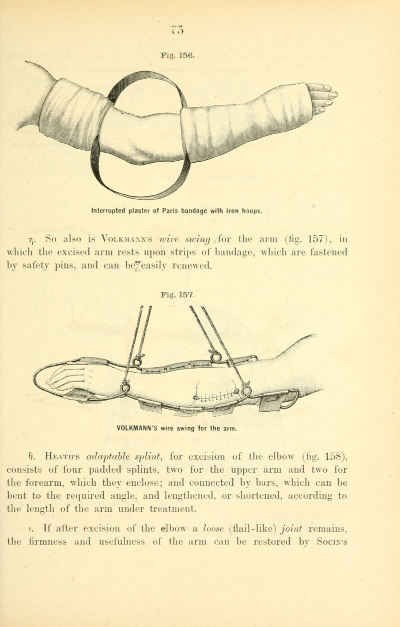 c .) Fig. 156. Interrupted plaster ot Paris bandage with iron hoops. r(. So also is Volkmanvs wire swing for the arm (fig. 157), in which the excised arm rests upon strips of bandage, which are fastened by safety pins, and can be^easily renewed. Fig. 157. VOLKMANN*S wire swing for the arm. 6. Heath's adaptable splint, for excision of the elbow (fig. 158), consists of four padded splints, two for the upper arm and two for the forearm, which they enclose; and connected by bars, which can be bent to the required angle, and lengthened, or shortened, according to the length of the arm under treatment. i. If after excision of the elbow a loose (flail-like) joint remains, the firmness and usefulness of the arm can be restored by Socivs