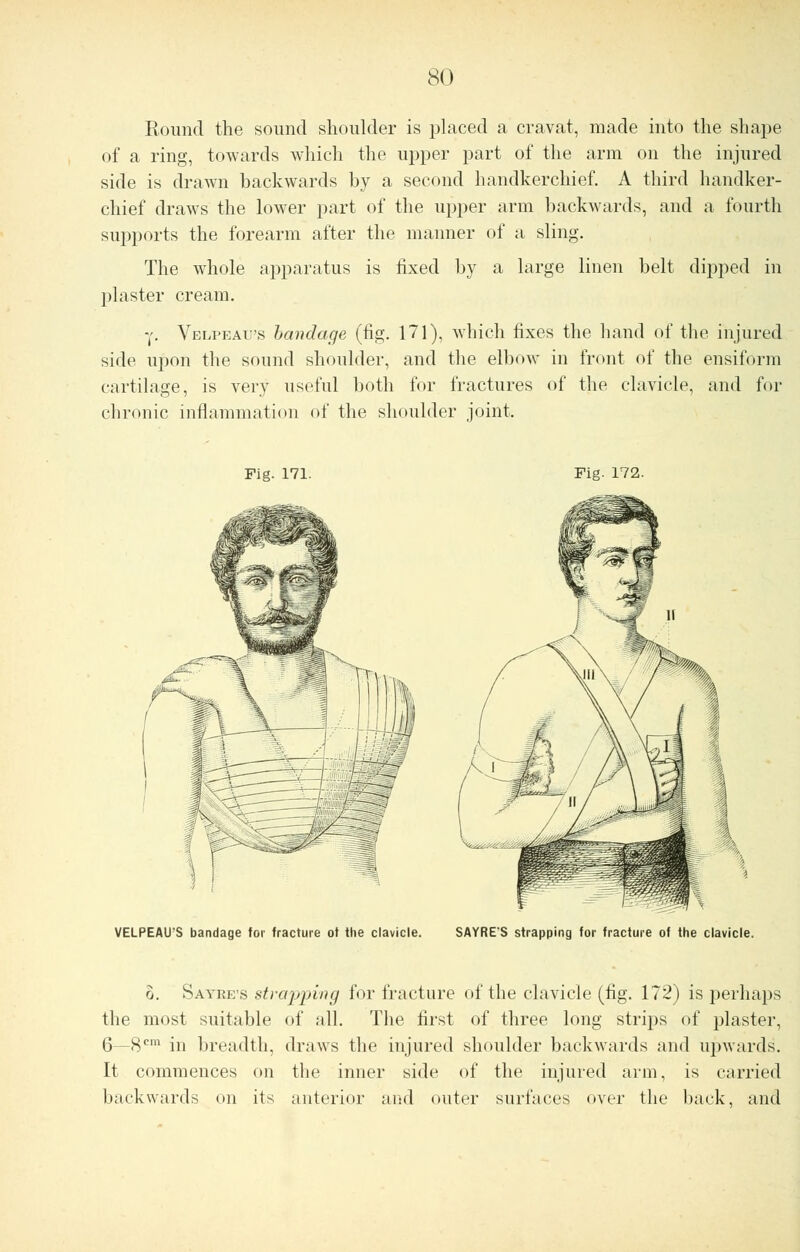 Round the sound shoulder is placed a cravat, made into the shape of a ring, towards which the upper part of the arm on the injured side is drawn backwards by a second handkerchief. A third handker- chief draws the lower part of the upper arm backwards, and a fourth supports the forearm after the manner of a sling. The whole apparatus is fixed by a large linen belt dipped in plaster cream. y. Velpeatj's bandage (fig. 171), which fixes the hand of the injured side upon the sound shoulder, and the elbow in front of the ensiform cartilage, is very useful both for fractures of the clavicle, and for chronic inflammation of the shoulder joint. Fig. 171. Fig. 172. VELPEAU'S bandage for fracture of the clavicle. SAYRE'S strapping for fracture of the clavicle. o. Sayre's strapping for fracture of the clavicle (fig. 172) is perhaps the most suitable of all. The first of three long strips of plaster, 6—8cm in breadth, draws the injured shoulder backwards and upwards. It commences on the inner side of the injured arm, is carried backwards on its anterior and outer surfaces over the back, and