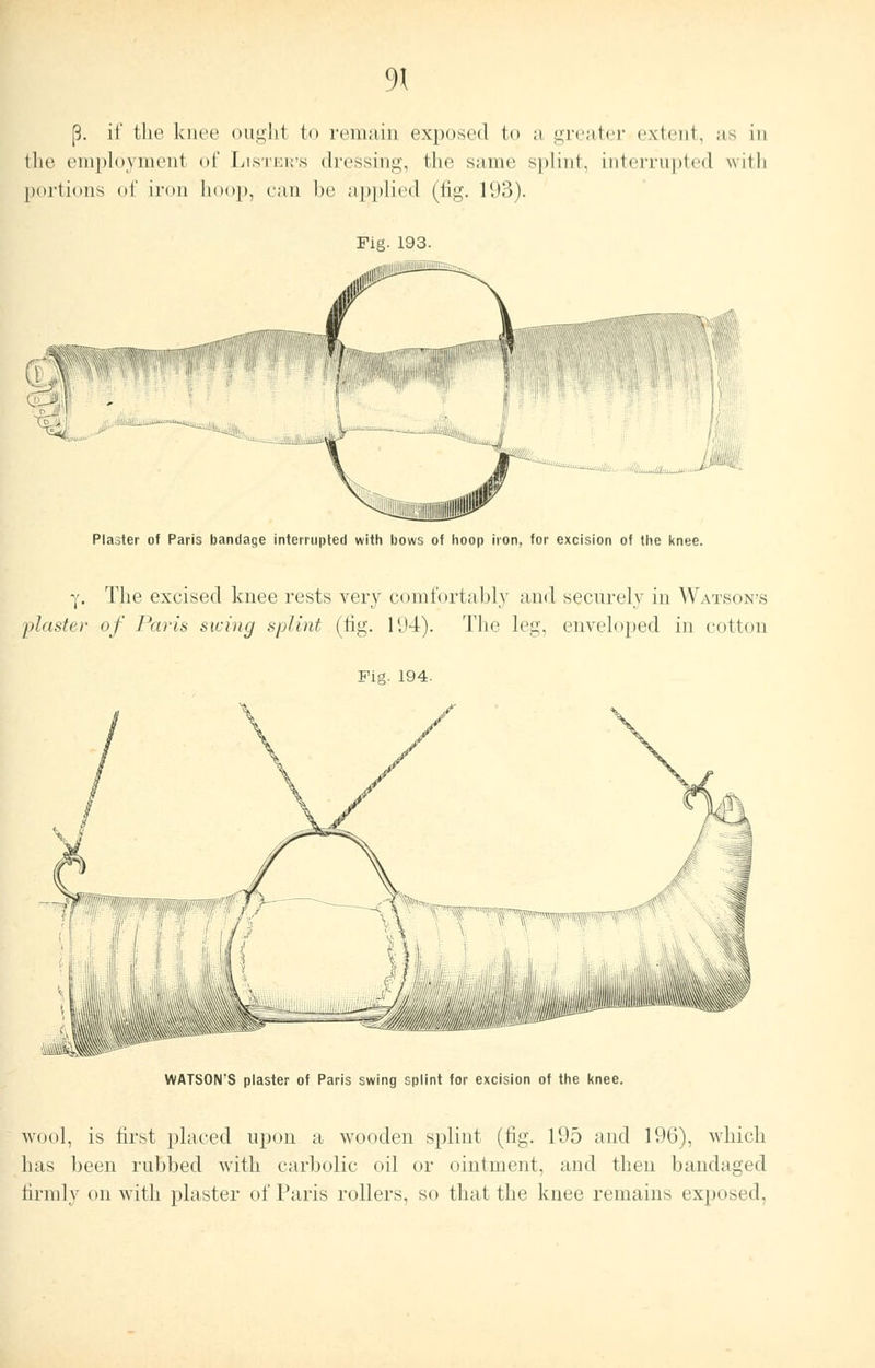 [5. it' the knee ought to remain exposed to a greater extent, as in the employment of Lister's dressing, the same splint, interrupted with portions of iron hoop, can be applied (fig. 193). m COM piiffff'lf'  ^yiii^jjiit iiii. < Plaster of Paris bandage interrupted with bows of hoop iron, for excision of the knee. -,'. The excised knee rests very comfortably and securely in Watson's j>l<ister of Paris swing splint (tig. 194). The leg, enveloped in cotton Fig. 194. WATSON'S piaster of Paris swing splint for excision of the knee. wool, is first placed upon a wooden splint (fig. 195 and 196), which has been rubbed with carbolic oil or ointment, and then bandaged firmly on with plaster of Paris rollers, so that the knee remains exposed,