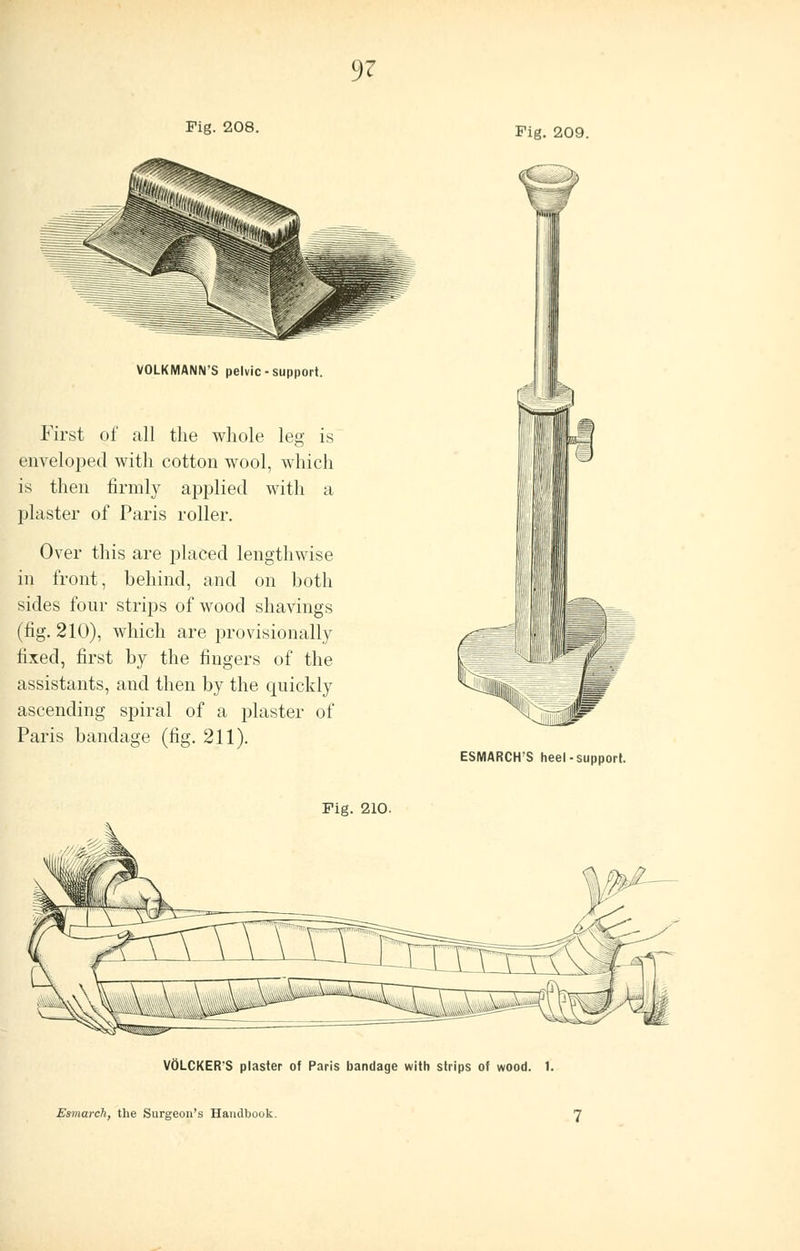 Fig. 208. Fig. 209. VOLKMANN'S pelvic - support. First of all the whole leg is enveloped with cotton wool, which is then firmly applied with a plaster of Paris roller. Over this are placed lengthwise in front, behind, and on both sides four strips of wood shavings (fig. 210), which are provisionally fixed, first by the fingers of the assistants, and then by the quickly ascending spiral of a plaster of Paris bandage (fig. 211). ESMARCH'S heel-support. Fig. 210. VOLCKER'S plaster of Paris bandage with strips of wood. 1. Esmarch, the Surgeon's Handbook. 7