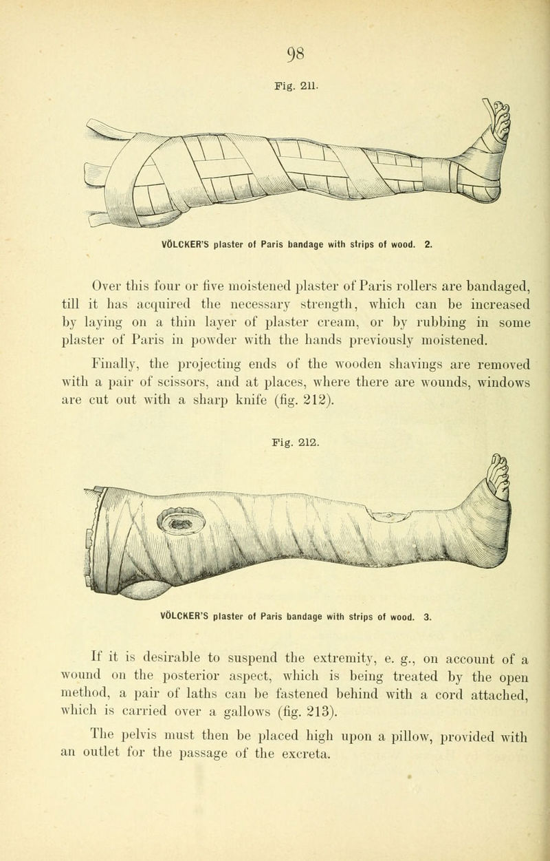 VOLCKER'S plaster of Paris bandage with strips of wood. 2. Over this four or five moistened plaster of Paris rollers are bandaged, till it has acquired the necessary strength, which can be increased by laying on a thin layer of plaster cream, or by rubbing in some plaster of Paris in powder with the hands previously moistened. Finally, the projecting ends of the wooden shavings are removed with a pair of scissors, and at places, where there are wounds, windows are cut out with a sharp knife (fig. 212). Fig. 212. VtiLCKER'S plaster of Paris bandage with strips of wood. 3. If it is desirable to suspend the extremity, e. g., on account of a wound on the posterior aspect, which is being treated by the open method, a pair of laths can be fastened behind with a cord attached, which is carried over a gallows (fig. 213). The pelvis must then be placed high upon a pillow, provided with an outlet for the passage of the excreta.