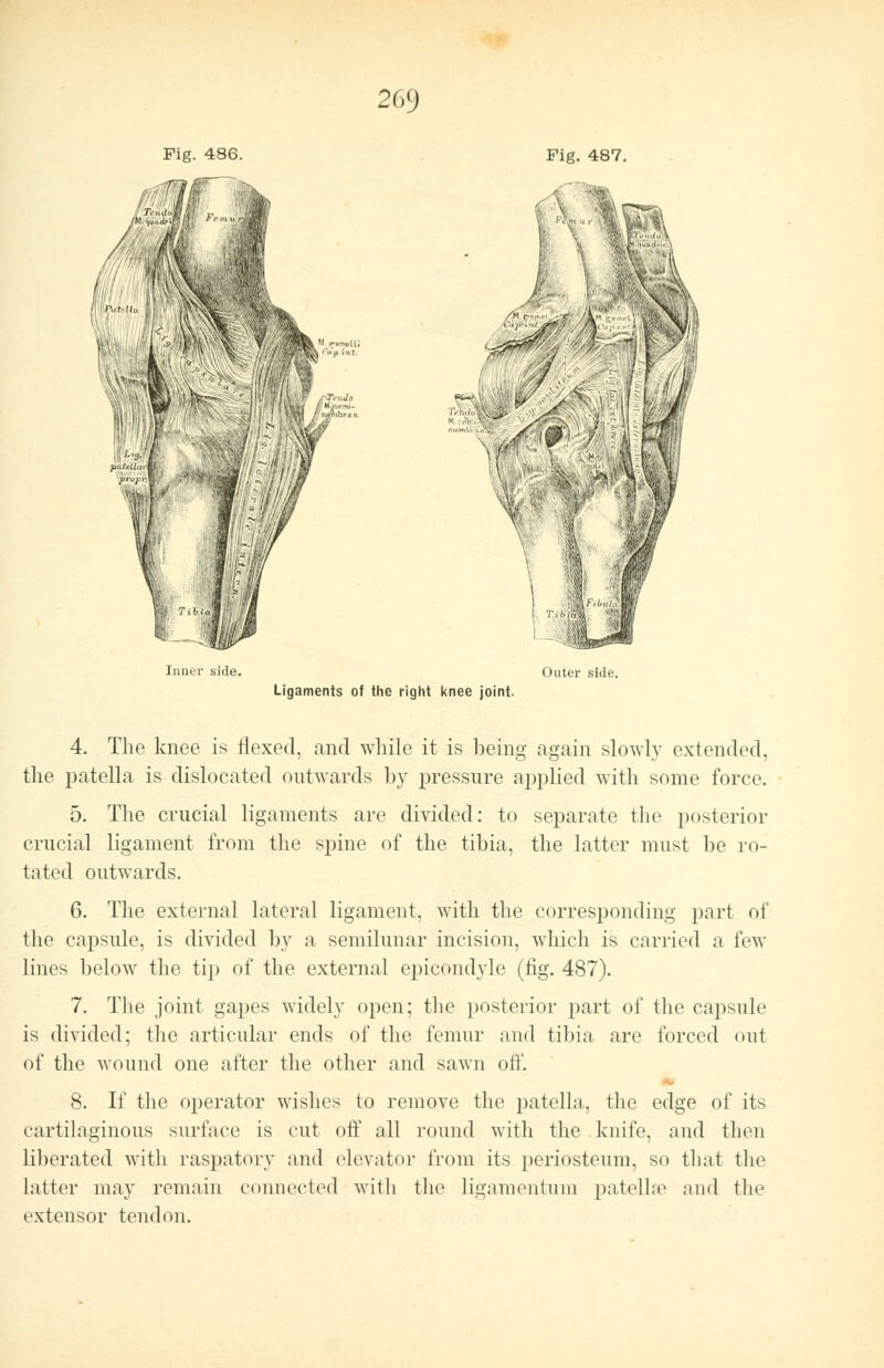 Fig. 487. /Mi-.. ,'.-« ,/A»W-,, ■ ; w .v' . .war, > ..> I -it - PTPrf Inner side. Outer side. Ligaments of the right knee joint. 4. The knee is flexed, and while it is being again slowly extended, the patella is dislocated outwards by pressure applied with some force. 5. The crucial ligaments are divided: to separate the posterior crucial ligament from the spine of the tibia, the latter must be ro- tated outwards. 6. The external lateral ligament, with the corresponding part of the capsule, is divided by a semilunar incision, which is carried a few lines below the tip of the external epicondyle (fig. 487). 7. The joint gapes widely open; the posterior part of the capsule is divided; the articular ends of the femur and tibia are forced ou1 of the wound one after the other and sawn off. 8. If the operator wishes to remove the patella, the edge of its cartilaginous surface is cut off all round with the knife, and then liberated with raspatory and elevator from its periosteum, so that the latter may remain connected with the ligamentum patellae and the extensor tendon.