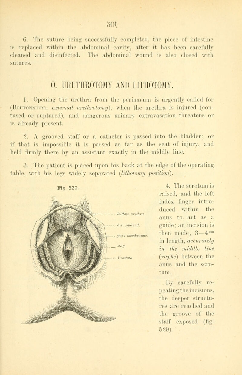 G. The suture being successfully completed, the piece of intestine is replaced within the abdominal cavity, after i( lias been carefully cleaned and disinfected. The abdominal wound is also closed with sutures. 0. URETHROTOMY AND LITHOTOMY. 1. Opening the urethra from the perinaeum is urgently called for (B.ouTONNifeRB, externa/ urethrotomy), when the urethra is injured (con- tused or ruptured), and dangerous urinary extravasation threatens or is already present. 2. A grooved stall' or a, catheter is passed into the bladder; or if that is impossible it is passed as far as the seat of injury, and held Rrmly there by an assistant exactly in the middle line. 3. The patient is placed upon his back at the edge of the operating table, with his legs widely separated (lithotomy position). Fig. 529. 4. The scrotum is raised, and the left index finger intro- duced within the anus to act as a guide; an incision is then made, 3—4cm in length, acturately in the middle line (raphe) between the anus and the scro- tum. By carefully re- peating the incisions, the deeper structu- res are reached and the groove of the staff exposed (fig. 529).