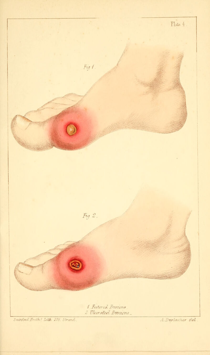 l),r / Tig 2. e: I Festered Burvwns Z Ulcerated. Bit, tTrocrwL. .Dva-lacAer dol