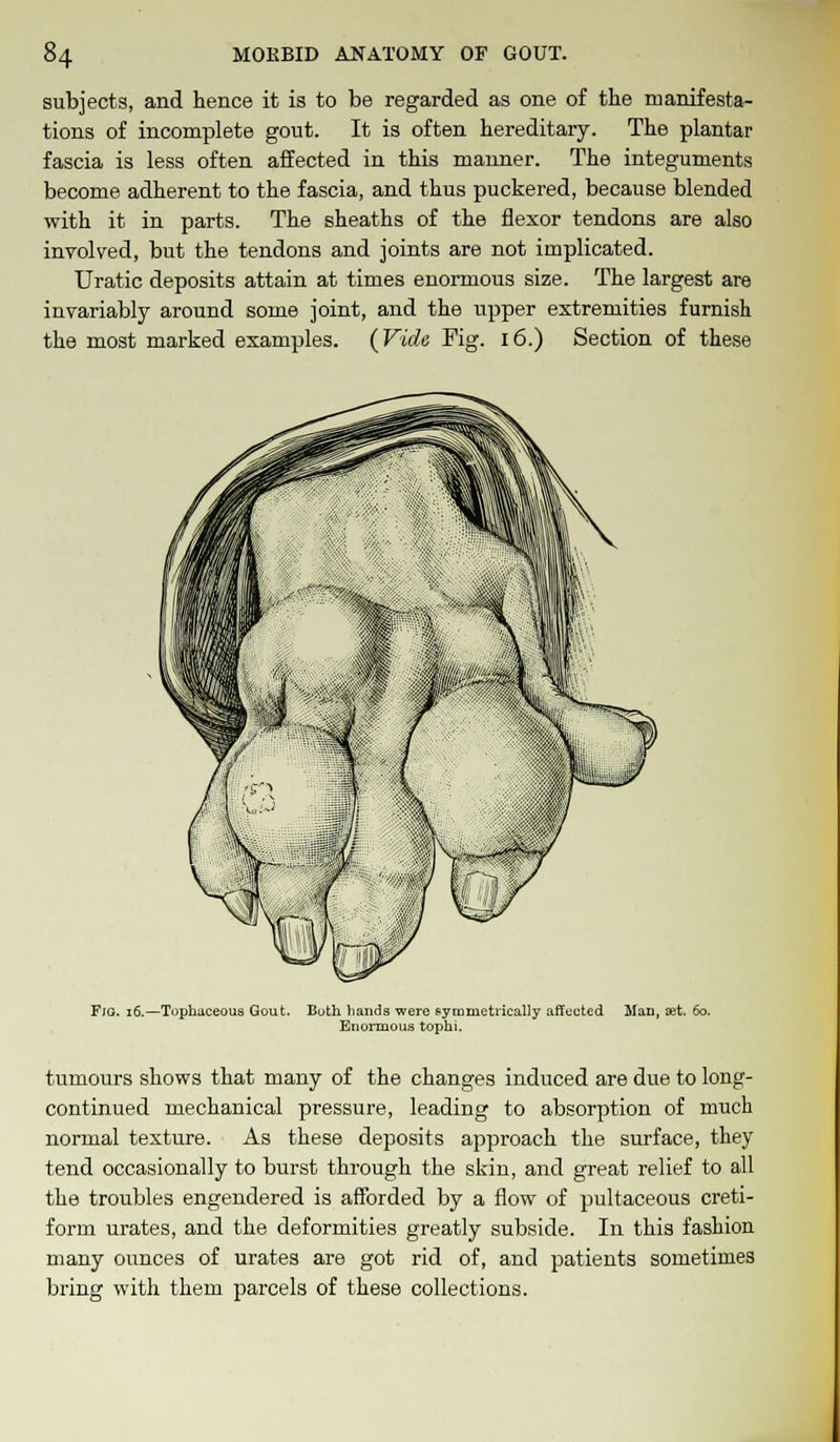 subjects, and hence it is to be regarded as one of the manifesta- tions of incomplete gout. It is often hereditary. The plantar fascia is less often affected in this manner. The integuments become adherent to the fascia, and thus puckered, because blended with it in parts. The sheaths of the flexor tendons are also involved, but the tendons and joints are not implicated. Uratic deposits attain at times enormous size. The largest are invariably around some joint, and the upper extremities furnish the most marked examples. (Vide Fig. 16.) Section of these Fjg. 16.—Tophaceous Gout. Both hands were symmetrically affected Man, set. 60. Enormous tophi. tumours shows that many of the changes induced are due to long- continued mechanical pressure, leading to absorption of much normal texture. As these deposits approach the surface, they tend occasionally to burst through the skin, and great relief to all the troubles engendered is afforded by a flow of pultaceous creti- forra urates, and the deformities greatly subside. In this fashion many ounces of urates are got rid of, and patients sometimes bring with them parcels of these collections.