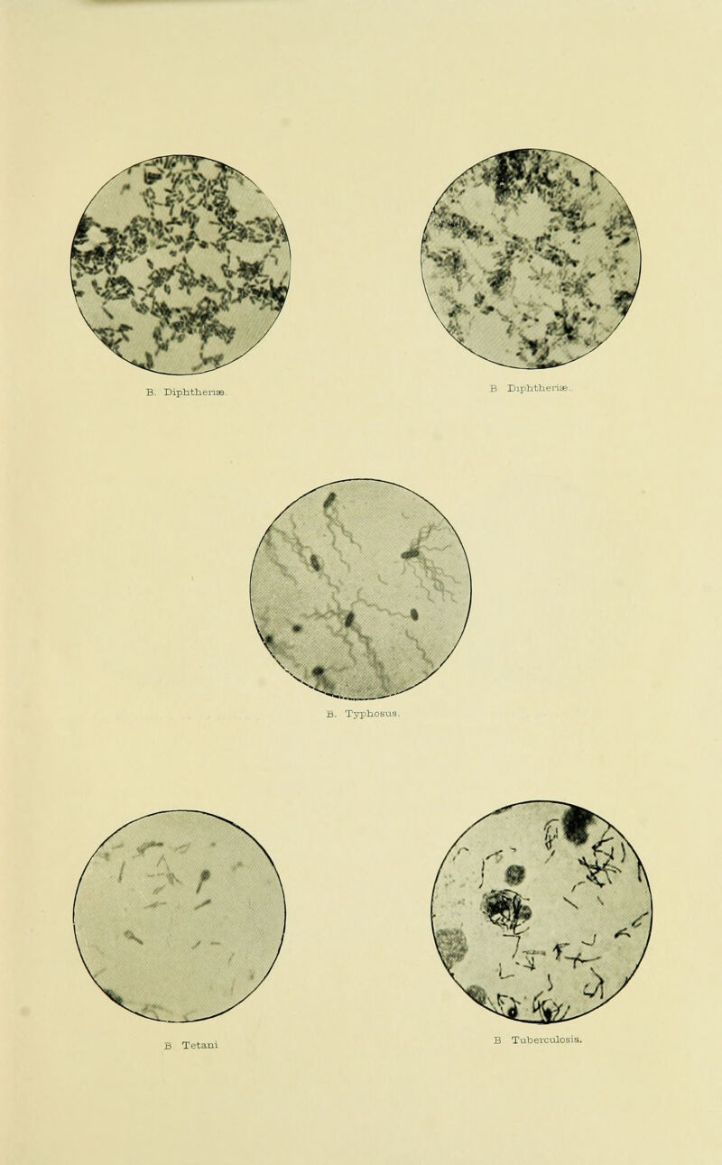 B. DipbtheriEe. B Diphtberise. Tabei-culosia.