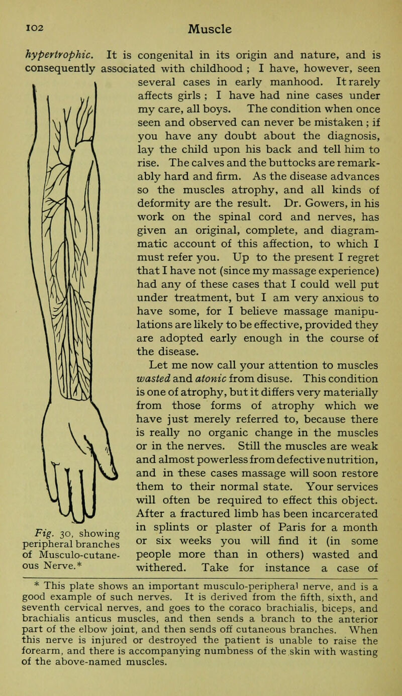 hypertrophic. It is congenital in its origin and nature, and is consequently associated with childhood ; I have, however, seen several cases in early manhood. It rarely affects girls ; I have had nine cases under my care, all boys. The condition when once seen and observed can never be mistaken; if /you have any doubt about the diagnosis, \J \ V lay the child upon his back and tell him to rise. The calves and the buttocks are remark- ably hard and firm. As the disease advances so the muscles atrophy, and all kinds of deformity are the result. Dr. Gowers, in his work on the spinal cord and nerves, has given an original, complete, and diagram- matic account of this affection, to which I must refer you. Up to the present I regret that I have not (since my massage experience) had any of these cases that I could well put under treatment, but I am very anxious to have some, for I believe massage manipu- lations are likely to be effective, provided they are adopted early enough in the course of the disease. Let me now call your attention to muscles wasted and atonic from disuse. This condition is one of atrophy, but it differs very materially from those forms of atrophy which we have just merely referred to, because there is really no organic change in the muscles or in the nerves. Still the muscles are weak and almost powerless from defective nutrition, and in these cases massage will soon restore them to their normal state. Your services will often be required to effect this object. After a fractured limb has been incarcerated in splints or plaster of Paris for a month or six weeks you will find it (in some people more than in others) wasted and withered. Take for instance a case of * This plate shows an important musculo-peripheral nerve, and is a good example of such nerves. It is derived from the fifth, sixth, and seventh cervical nerves, and goes to the coraco brachialis, biceps, and brachialis anticus muscles, and then sends a branch to the anterior part of the elbow joint, and then sends off cutaneous branches. When this nerve is injured or destroyed the patient is unable to raise the forearm, and there is accompanying numbness of the skin with wasting of the above-named muscles. Fig. 30, showing peripheral branches of Musculocutane- ous Nerve.*