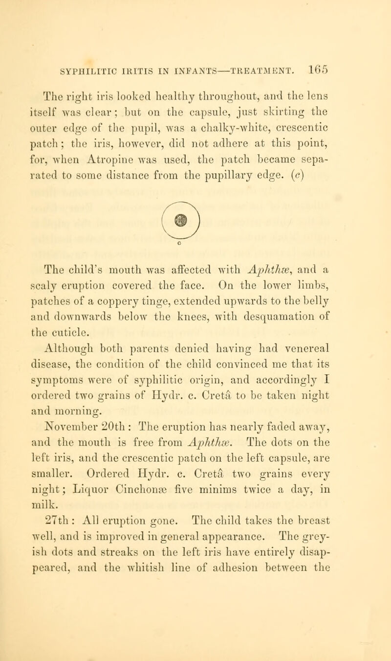 The right iris looked healthy throughout, and the lens itself was clear; but on the capsule, just skirting the outer edge of the pupil, was a chalky-white, crescentic patch ; the iris, however, did not adhere at this point, for, when Atropine was used, the patch became sepa- rated to some distance from the pupillary edge, (e) The child's mouth was affected with Aphthse, and a scaly eruption covered the face. On the lower limbs, patches of a coppery tinge, extended upwards to the belly and downwards below the knees, with desquamation of the cuticle. Although both parents denied having had venereal disease, the condition of the child convinced me that its symptoms were of syphilitic origin, and accordingly I ordered two grains of Hydr. c. Creta to be taken night and morning. November 20th : The eruption has nearly faded away, and the mouth is free from Aflitlise. The dots on the left iris, and the crescentic patch on the left capsule, are smaller. Ordered Hydr. c. Creta two grains every night; Liquor Cinchona five minims twice a day, in milk. 27th : AH eruption gone. The child takes the breast well, and is improved in general appearance. The grey- ish dots and streaks on the left iris have entirely disap- peared, and the whitish line of adhesion between the