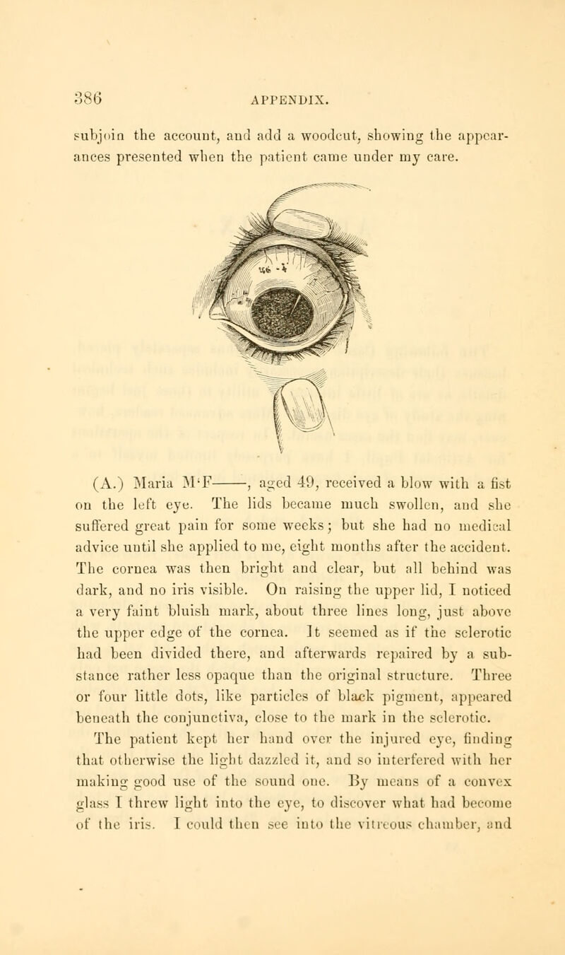 subjoin the account, and add a woodcut, showing the appear- ances presented when the patient came under my care. (A.) Maria M'F , aged 49, received a blow with a fist on the left eye. The lids became much swollen, and she suffered great pain for some weeks; but she had no medical advice until she applied to me, eight months after the accident. The cornea was then bright and clear, but all behind was dark, and no iris visible. On raising the upper lid, I noticed a very faint bluish mark, about three lines long, just above the upper edge of the cornea. It seemed as if the sclerotic had been divided there, and afterwards repaired by a sub- stance rather less opaque than the original structure. Three or four little dots, like particles of black pigment, appeared beneath the conjunctiva, close to the mark in the sclerotic. The patient kept her hand over the injured eye, finding that otherwise the light dazzled it, and so interfered with her making good use of the sound one. By means of a convex glass 1 threw light into the eye, to discover what had become of the iris. I could then see into the vitreous chamber, and