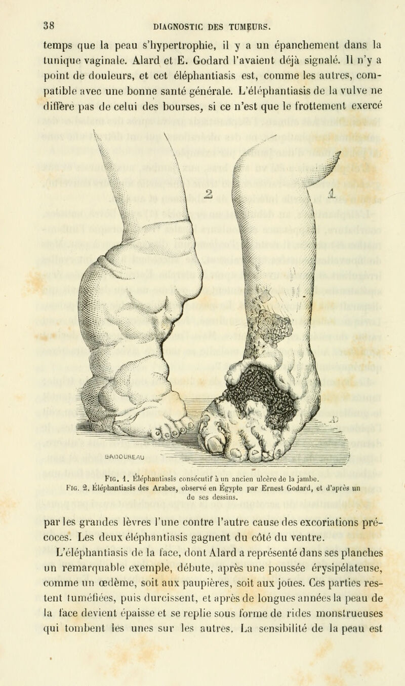 temps que la peau s'hypertrophie, il y a un épanchement dans la tunique vaginale. Alard et E. Godard l'avaient déjà signalé. 11 n'y a point de douleurs, et cet éléphantiasis est, comme les autres, com- patible avec une bonne santé générale. L'élépliantiasis de la vulve ne diffère pas de celui des bourses, si ce n'est que le frottement exercé Fig. 1. Éléphantiasis consécutif à un ancien ulcère de la jambe. Fig. 2. Eléphantiasis des Arabes, observé en Egypte par Ernest Godard, et d'après un de ses dessins. parles grandes lèvres l'une contre l'autre cause des excoriations pré- coces. Les deux éléphantiasis gagnent du côté du ventre. L'élépliantiasis de la face, dont Alard a représenté dans ses planches un remarquable exemple, débute, après une poussée érysipélateuse, comme un œdème, soit aux paupières, soit aux joues. Ces parties res- tent tuméfiées, puis durcissent, et après de longues années la peau de la face devient épaisse et se replie sous forme de rides monstrueuses qui tombent les unes sur les autres, La sensibilité de la peau est