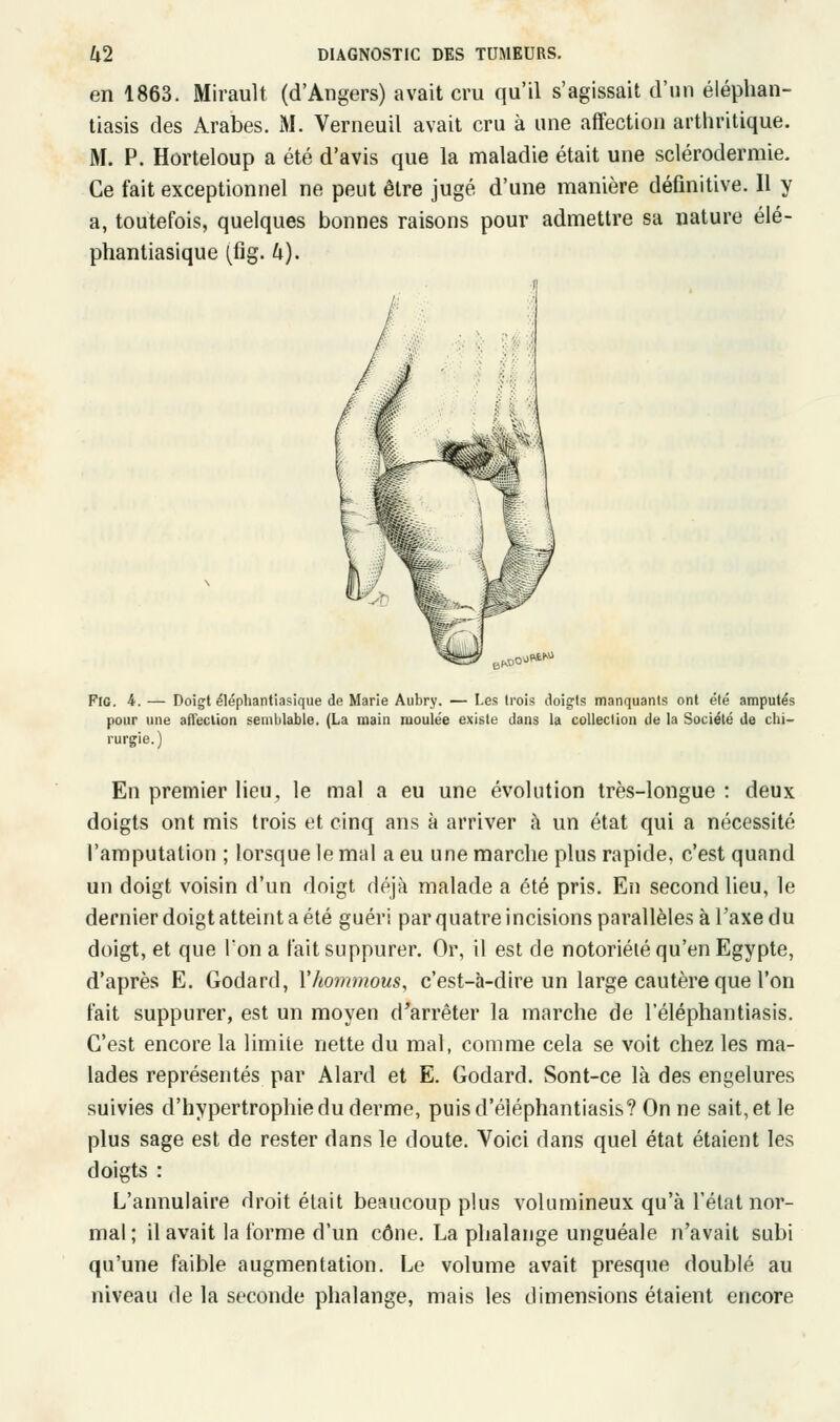 en 1863. Mirault (d'Angers) avait cru qu'il s'agissait d'un éléphan- tiasis des Arabes. M. Verneuil avait cru à une affection arthritique. M. P. Horteloup a été d'avis que la maladie était une scléroderraie. Ce fait exceptionnel ne peut être jugé d'une manière définitive. Il y a, toutefois, quelques bonnes raisons pour admettre sa nature élé- phantiasique (fig. h). Fig. 4. — Doigt éléphantiasique de Marie Aubry. — Les trois doigts manquants ont été amputés pour une affection semblable. (La main moulée existe dans la collection de la Société de chi- rurgie.) En premier lieu, le mal a eu une évolution très-longue : deux doigts ont mis trois et cinq ans à arriver à un état qui a nécessité l'amputation ; lorsque le mal a eu une marche plus rapide, c'est quand un doigt voisin d'un doigt déjà malade a été pris. En second lieu, le dernier doigt atteint a été guéri par quatre incisions parallèles à Taxe du doigt, et que Ion a fait suppurer. Or, il est de notoriété qu'en Egypte, d'après E. Godard, Yhommous, c'est-à-dire un large cautère que l'on fait suppurer, est un moyen d'arrêter la marche de l'éléphantiasis. C'est encore la limite nette du mal, comme cela se voit chez les ma- lades représentés par Alard et E. Godard. Sont-ce là des engelures suivies d'hypertrophie du derme, puisd'éléphantiasis? On ne sait, et le plus sage est de rester dans le doute. Voici dans quel état étaient les doigts : L'annulaire droit était beaucoup plus volumineux qu'à l'état nor- mal ; il avait la forme d'un cône. La phalange unguéale n'avait subi qu'une faible augmentation. Le volume avait presque doublé au niveau de la seconde phalange, mais les dimensions étaient encore