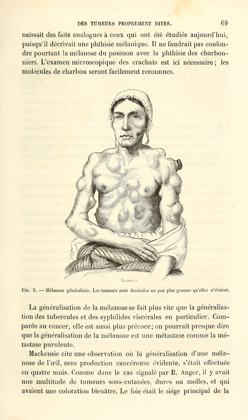 naissait des faits analogues à ceux qui ont été étudiés aujourd'hui, puisqu'il décrivait une phthisie mélanique. Il ne faudrait pas confon- dre pourtant la mélanose du poumon avec la phthisie des charbon- niers. L'examen microscopique des crachats est ici nécessaire ; les molécules de charbon seront facilement reconnues. Blajiaoct Fig. 5. — Mélanose généralisée. Les tumeurs sont dessinées un peu plus grosses qu'elles n'étaient. La généralisation de la mélanose se fait plus vite que la généralisa- tion des tubercules et des syphilides viscérales en particulier. Com- parée au cancer, elle est aussi plus précoce; on pourrait presque dire que la généralisation de la mélanose est une métastase comme la mé- tastase purulente. Mackensie cite une observation où la généralisation d'une méla- nose de l'œil, sans production cancéreuse évidente, s'était effectuée en quatre mois. Comme dans le cas signalé par E. Anger, il y avait une multitude de tumeurs sous-cutanées, dures ou molles, et qui avaient une coloration bleuâtre. Le foie était le siège principal de la