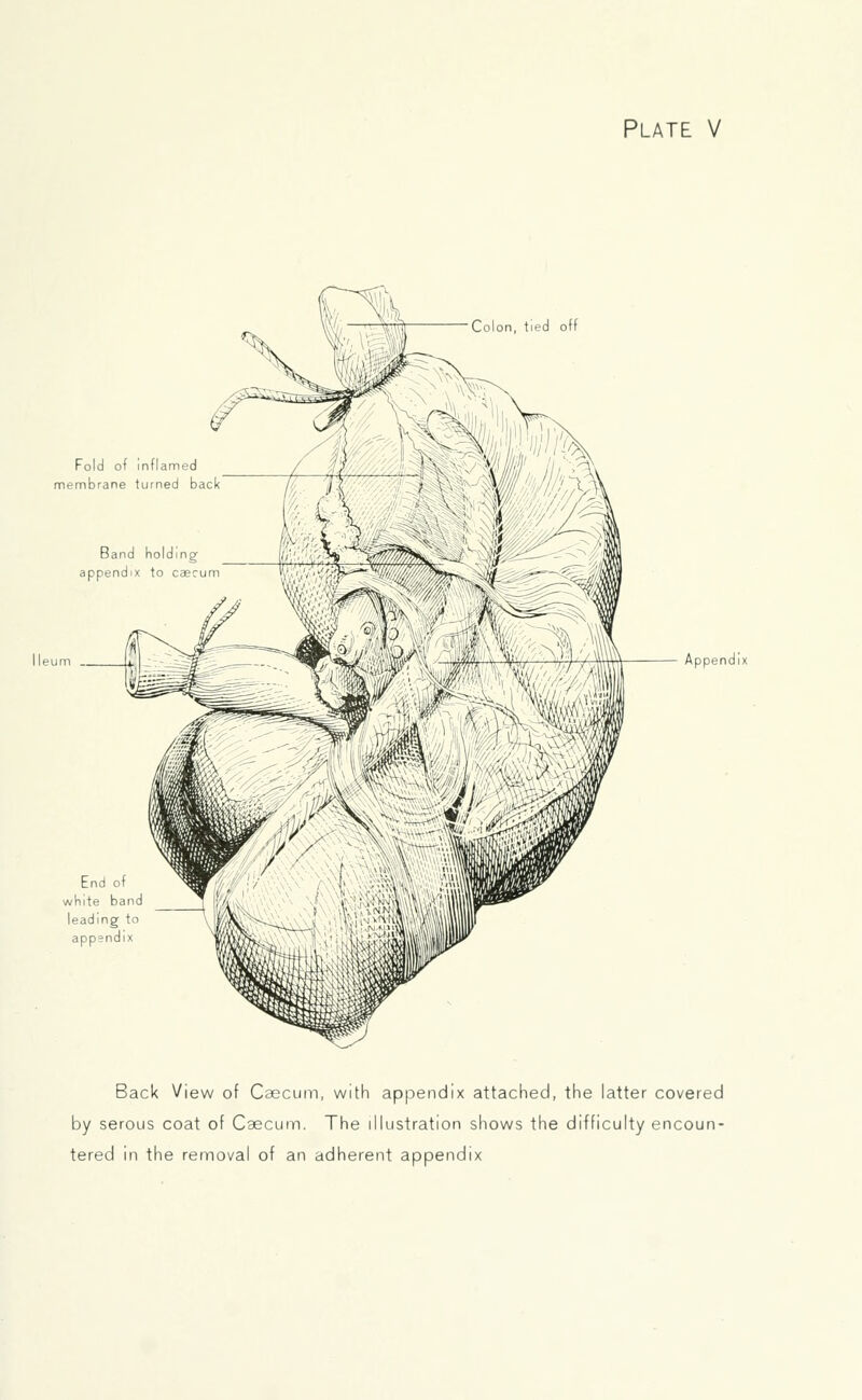 Plate V End of white ba leading appendi Appendi Back View of Caecum, with appendix attached, the latter covered by serous coat of Caecum. The illustration shows the difficulty encoun- tered in the removal of an adherent appendix