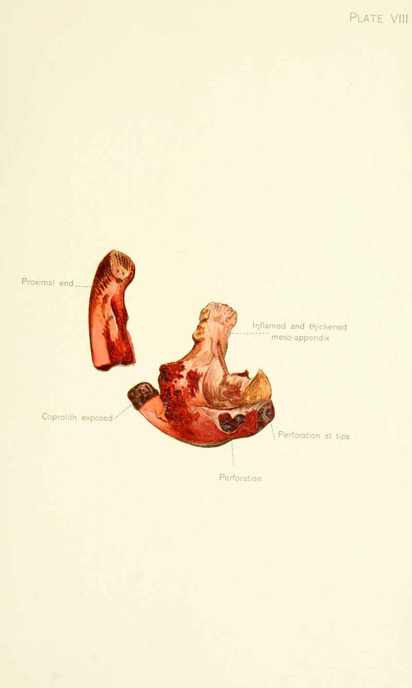 Proximal end. Coprolith exposed Iqflamed and thjckened meso-appendix '. Perforation at tips Perforation