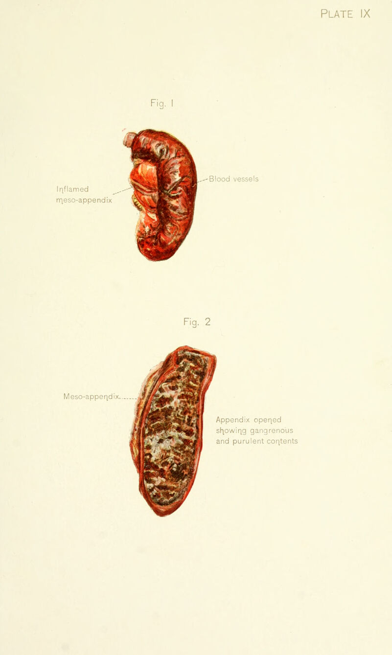 '9- Iriflamed rr\eso-appendix ,--Blood vessels Fig. 2 Meso-appeqdix. Appendix opeqed sh.owiqg gangrenous and purulent coqtents