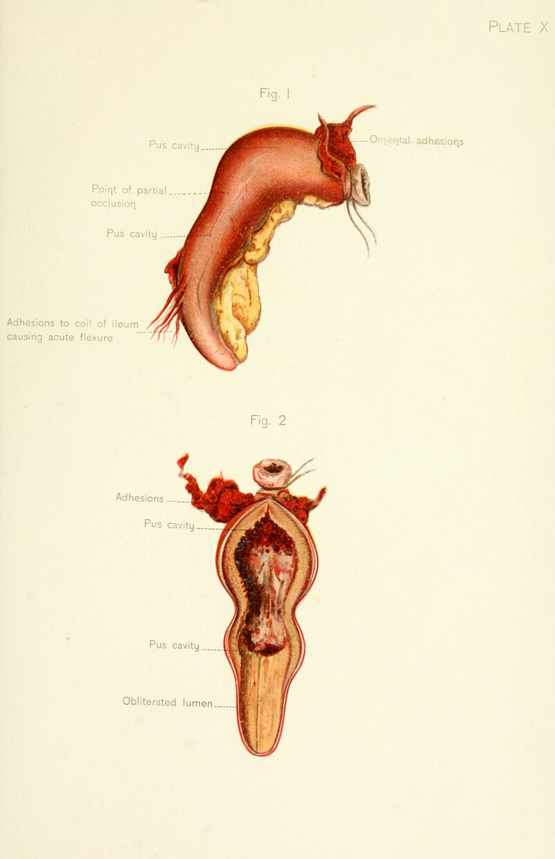 Adhesions to coil of ileum causing acute flexure il adhesions Fig. 2