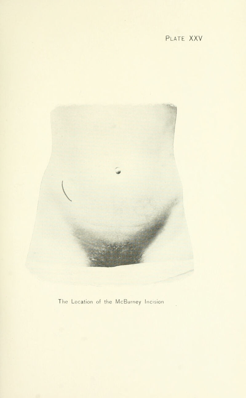 V The Location of the McBumey Incision