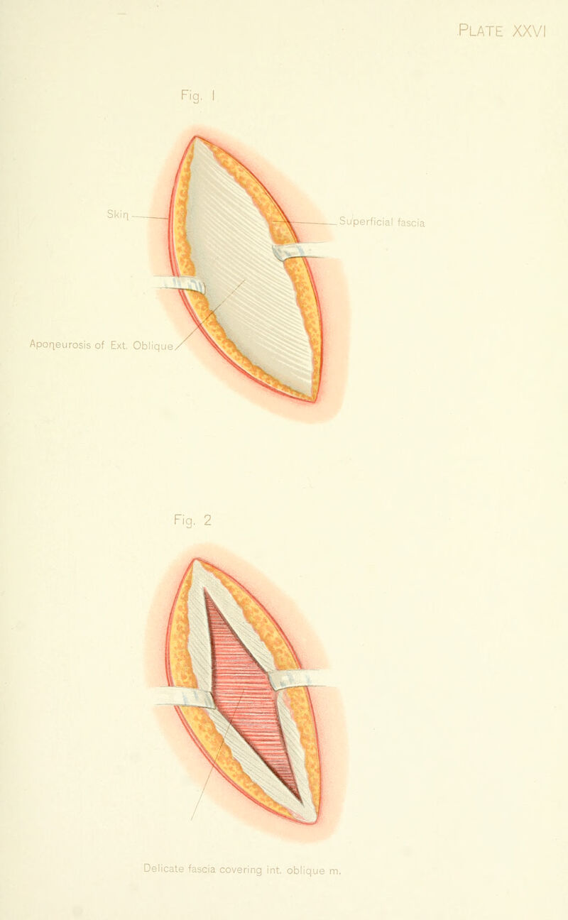 Skiq - Aponeurosis of Ext, Oblique .Superficial fascia Fig. 2 Delicate fascia covering int. oblique m.