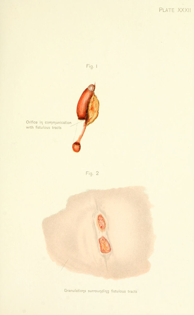 Fig. I Plate XXXll Orifice iq corqiriunication ..- with fistulous tracts 0 Fig. 2 Granulations surrouqdiqg fistulous tracts