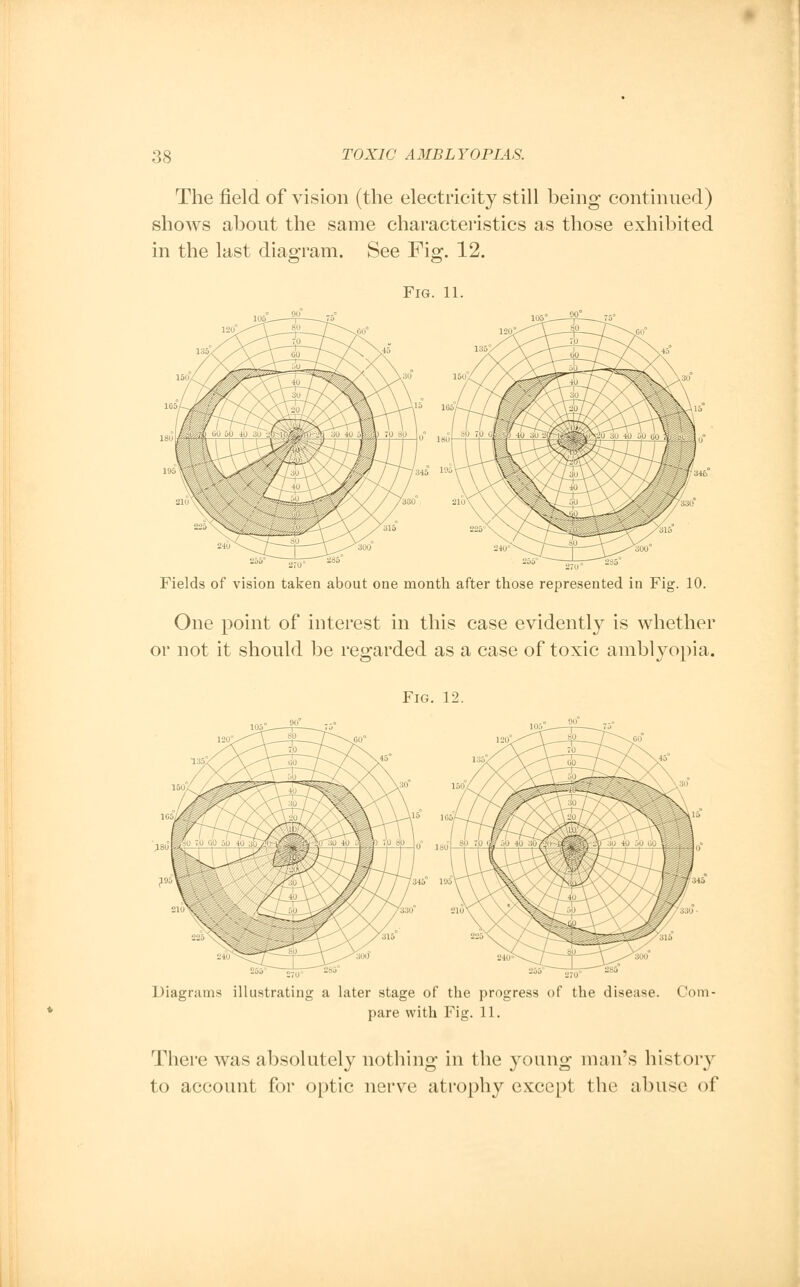 The field of vision (the electricity still being continued) shows about the same characteristics as those exhibited in the last diagram. See Fig. 12. Fig. 11. Fields of vision taken about one month after those represented in Fig. 10. One point of interest in this case evidently is whether or not it should be regarded as a case of toxic amblyopia. Fig. 12. Diagrams illustrating a later stage of the progress of the disease. Com- pare with Fig. 11. There was absolutely nothing in the young man's history to account for optic nerve atrophy except the abuse of