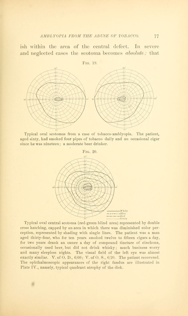 ish within the area of the central defect. In severe and neglected cases the scotoma becomes absolute; that Fig. 19. 90 • I li i ' Typical oval scotomas from a case of tobacco-amblyopia. The patient, aged sixty, bad smoked four pipes of tobacco daily and an occasional cigar since he was nineteen ; a moderate beer drinker. Fig. 20. Typical oval central scotoma (red-green-blind area) represented by double cross hatching, capped by an area in which there was diminished color per- ception, represented by shading with single lines. The patient was a man aged thirty-four, who for ten years smoked twelve to fifteen cigars a day, for two years drank an ounce a day of compound tincture of cinchona, occasionally used beer, but did not drink whisky; much business worry and many sleepless nights. The visual field of the left eye was almost exactly similar. V. of O. D., 6/60; V. of O. S., 6/20. The patient recovered. The ophthalmoscopic appearances of the right fundus are illustrated in Plate IV., namely, typical quadrant atrophy of the disk.