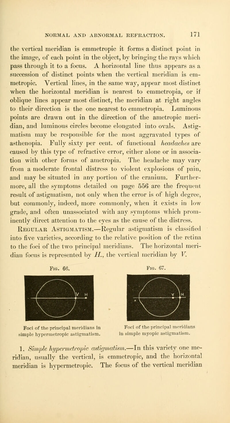 the vertical meridian is emmetropic it forms a distinct point in the image, of each point in the object, by bringing the rays which pass through it to a focus. A horizontal line thus appears as a succession of distinct points when the vertical meridian is em- metropic. Vertical lines, in the same way, appear most distinct when the horizontal meridian is nearest to emmetropia, or if oblique lines appear most distinct, the meridian at right angles to their direction is the one nearest to emmetropia. Luminous points are drawn out in the direction of the ametropic meri- dian, and luminous circles become elongated into ovals. Astig- matism may be responsible for the most aggravated types of asthenopia. Fully sixty per cent, of functional headaches are caused by this type of refractive error, either alone or in associa- tion with other forms of ametropia. The headache may vary from a moderate frontal distress to violent explosions of pain, and may be situated in any portion of the cranium. Further- more, all the symptoms detailed on page 556 are the frequent result of astigmatism, not only when the error is of high degree, but commonly, indeed, more commonly, when it exists in low grade, and often unassociated with any symptoms which prom- inently direct attention to the eyes as the cause of the distress. Regular Astigmatism.—Regular astigmatism is classified into five varieties, according to the relative position of the retina to the foci of the two principal meridians. The horizontal meri- dian focus is represented by H., the vertical meridian by V. Fig. 66. Fig. 67. Foci of the principal meridians in simple hypermetropic astigmatism. Foci of the principal meridians in simple myopic astigmatism. 1. Simple hypermetropic astigmatism.—In this variety one me- ridian, usually the vertical, is emmetropic, and the horizontal meridian is hypermetropic. The focus of the vertical meridian