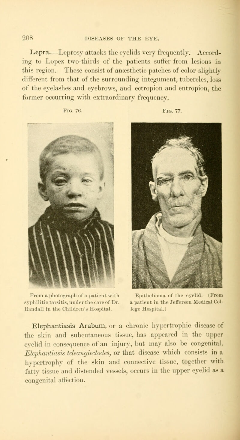 Lepra.—Leprosy attacks the eyelids very frequently. Accord- ing to Lopez two-thirds of the patients suffer from lesions in this region. These consist of anaesthetic patches of color slightly different from that of the surrounding integument, tubercles, loss of the eyelashes and eyebrows, and ectropion and entropion, the former occurring with extraordinary frequency. Fig. 76. Fig. 77. From a photograph of a patient with syphilitic tarsitis, under the care of Dr. Randall in the Children's Hospital. Epithelioma of the eyelid. (From a patient in the Jefferson Medical Col- lege Hospital.) Elephantiasis Arabum, or a chronic hypertrophic disease of the skin and subcutaneous tissue, has appeared in the upper evelid in consequence of an injury, but may also be congenital. Elephantiasis teleangiectodes, or that disease which consists in a hypertrophy of the skin and connective tissue, together with fatty tissue and distended vessels, occurs in the upper eyelid as a congenital affection.