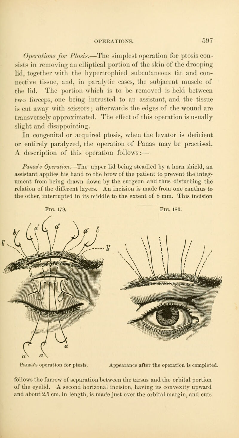 Operations for Ptosis.—The simplest operation for ptosis con- >i-ts in removing an elliptical portion of the skin of the drooping lid, together with the hypertrophied subcutaneous fat and con- nective tissue, and, in paralytic eases, the subjacent muscle of the lid. The portion which is to be removed is held between two forceps, one being intrusted to an assistant, and the tissue is cut away with scissors ; afterwards the edges of the wound are transversely approximated. The effect of this operation is usually slight and disappointing. In congenital or acquired ptosis, when the levator is deficient or entirely paralyzed, the operation of Panas may be practised. A description of this operation follows:— Panas's Operation.—The upper lid being steadied by a horn shield, an assistant applies his hand to the brow of the patient to prevent the integ- ument from being drawn down by the surgeon and thus disturbing the relation of the different layers. An incision is made from one canthus to the other, interrupted in its middle to the extent of 8 mm. This incision Fig. 179. Fig. 180. -V Panas's operation for ptosis. Appearance after the operation is completed. follows the furrow of separation between the tarsus and the orbital portion of the eyelid. A second horizonal incision, having its convexity upward and about 2.5 cm. in length, is made just over the orbital margin, and cuts