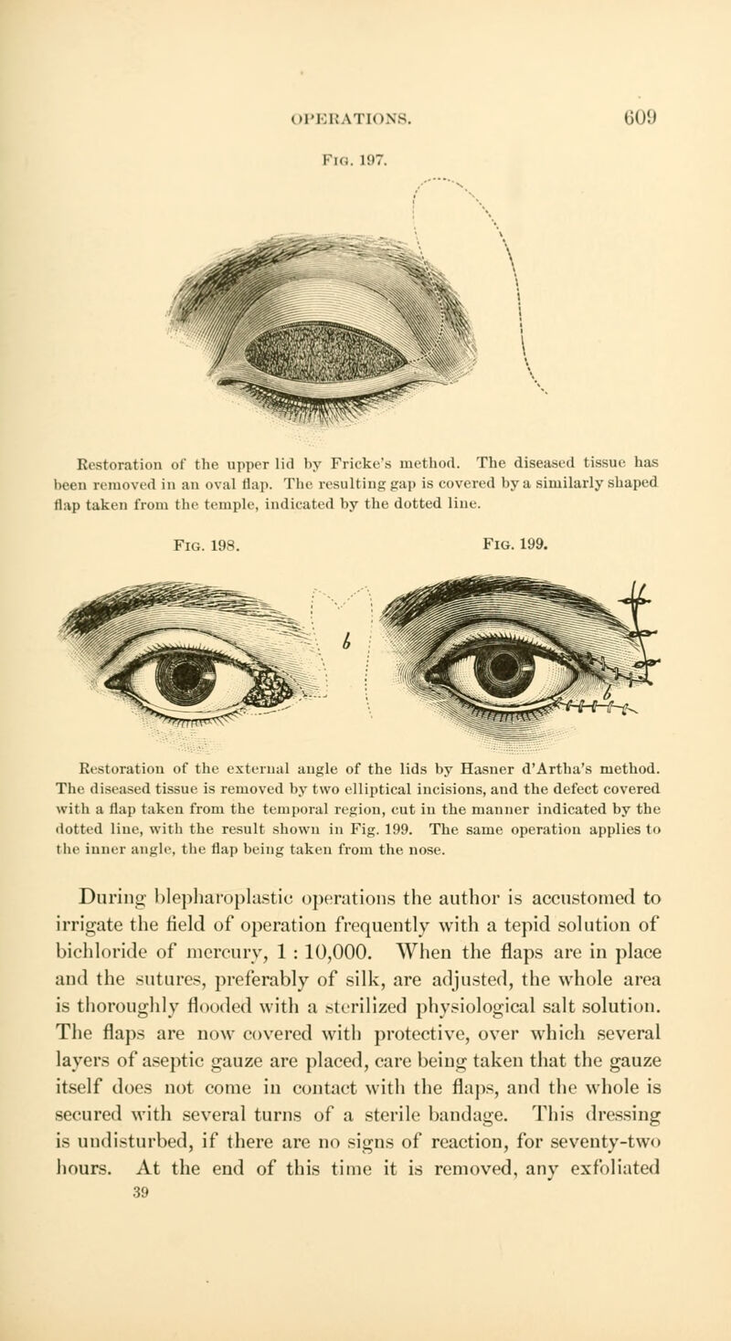 Fk;. 1!>7. Restoration of the upper lid by Frieke's method. The diseased tissue; has been removed in an oval nap. The resulting gap is covered by a similarly shaped Hap taken from the temple, indicated by the dotted line. Fig. 198. Fig. 199. Restoration of the external angle of the lids by Hasner d'Artha's method. The diseased tissue is removed by two elliptical incisions, and the defect covered with a flap taken from the temporal region, cut iu the manner indicated by the dotted Hue, with the result shown in Fig. 199. The same operation applies to the inner angle, the flap being taken from the nose. During- blepharoplastic operations the author is accustomed to irrigate the field of operation frequently with a tepid solution of bichloride of mercury, 1 : 10,000. When the flaps are in place ami the sutures, preferably of silk, are adjusted, the whole area is thoroughly flooded with a sterilized physiological salt solution. The flaps are now covered with protective, over which several layers of aseptic gauze are placed, care being taken that the gauze itself does not come in contact with the flaps, and the whole is secured with several turns of a sterile bandage. This dressing is undisturbed, if there are no signs of reaction, for seventy-two hours. At the end of this time it is removed, any exfoliated 39