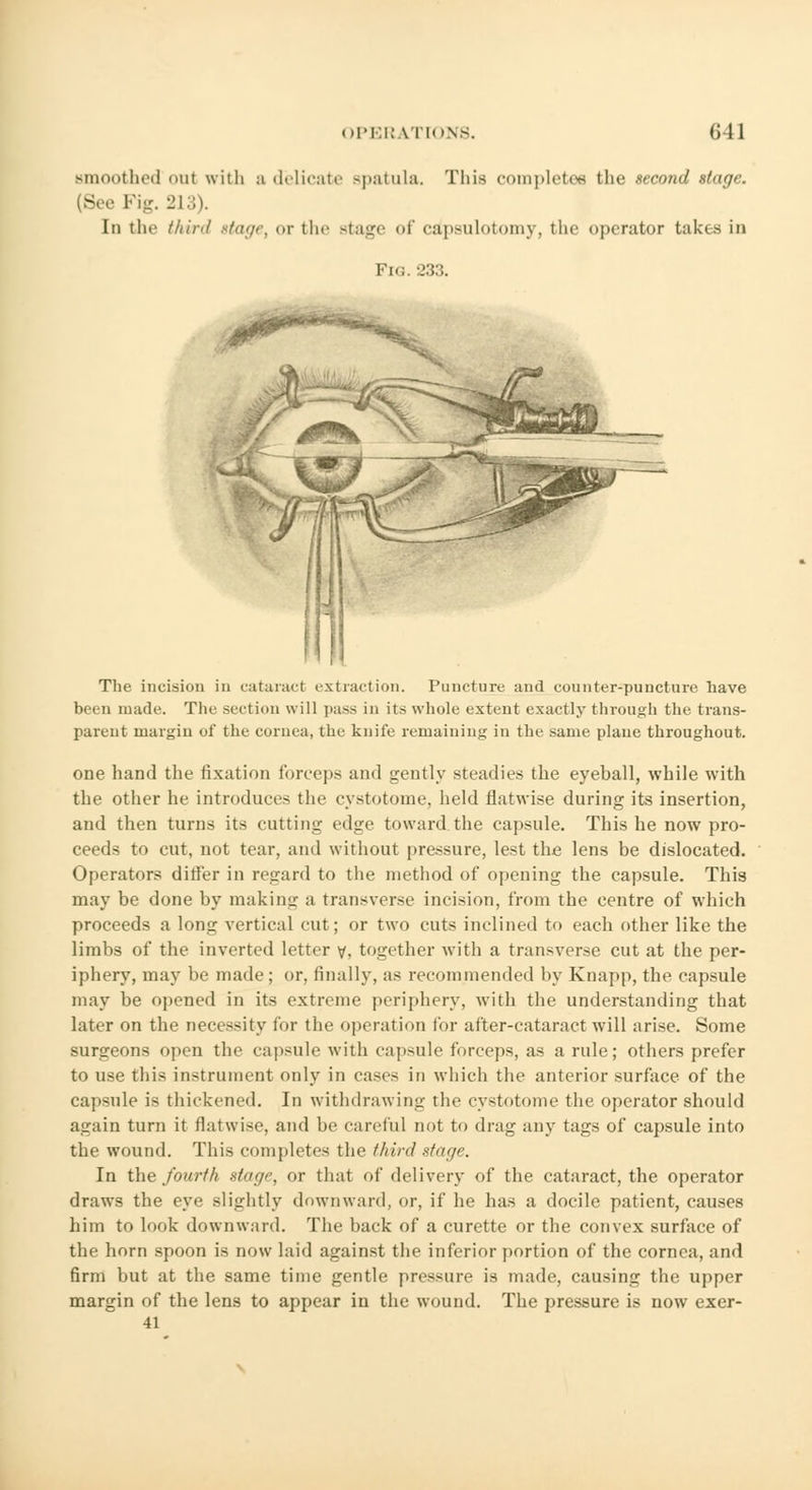 unoothed <mt with a delicate Bpatula. This completes the second stage. (See Fig. 213). In the third stage, or the stage of ca'psulotomy, the < tptrator takes in Fig, 233. The incision in cataract extraction. Puncture and counter-puncture have been made. The section will pass in its whole extent exactly through the trans- parent margin of the cornea, the knife remaining in the same plane throughout. one hand the fixation foreeps and gently steadies the eyeball, while with the other he introduces the cystotome, held flatwise during its insertion, and then turns its cutting edge toward the capsule. This he now pro- ceeds to cut, not tear, and without pressure, lest the lens be dislocated. Operators differ in regard to the method of opening the capsule. This may be done by making a transverse incision, from the centre of which proceeds a long vertical cut; or two cuts inclined to each other like the limbs of the inverted letter v. together with a transverse cut at the per- iphery, may be made; or, finally, as recommended by Knapp, the capsule may be opened in its extreme periphery, with the understanding that later on the necessity for the operation for after-cataract will arise. Some surgeons open the capsule with capsule forceps, as a rule; others prefer to use this instrument only in cases in which the anterior surface of the capsule is thickened. In withdrawing the cystotome the operator should again turn it flatwise, and be careful not to drag any tags of capsule into the wound. This completes the third Mage. In the fourth stage, or that of delivery of the cataract, the operator draws the eye slightly downward, or, if he has a docile patient, causes him to look downward. The back of a curette or the convex surface of the horn spoon is now laid against the inferior portion of the cornea, and firm but at the same time gentle pressure is made, causing the upper margin of the lens to appear in the wound. The pressure is now exer- 41