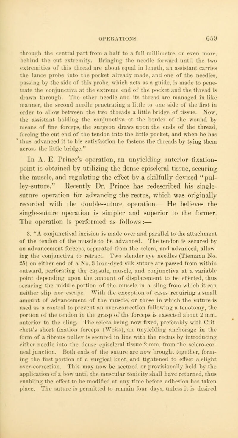 through the central part from a half to a Full millimetre, <>r even more, behind the cut extremity. Bringing the needle forward until the two extremities of this thread arc about equal in length, an assistant carries the lance probe into the pocket already made, and one of the needles, passing by the side of this probe, which acta a- a guide, is made to pene- trate the conjunctiva at the extreme end of the pocket and the thread is drawn through. The other needle and it> thread arc managed in like manner, the second needle penetrating a little to one side of the first in order to allow between the two threads a little bridge of tissue. Now, the assistant holding the conjunctiva at the border of the wound by means of fine forceps, the surgeon draws upon the ends of the thread, forcing the cut end of the tendon into the little pocket, and when he has thus advanced it to his satisfaction he fasten- the tbreads by tying them across the little bridge. In A. E. Prince's operation, an unyielding anterior hxatiou- poinl i- obtained by utilizing the dense episcleral tissue, securing the muscle, and regulating the effect by a skilfully devised pul- ley-suture. Recently Dr. Prince has redescribed his single- suture operation for advancing the rectus, which was originally nc.nled with the double-suture operation. He believes the -in^le-suture operation is simpler and superior to the former. The operation is performed as follows:— ... A conjunctival incision is made over and parallel to the attachment of the tendon of the muscle to be advanced. The tendon is secured by an advancement forceps, separated from the sclera, and advanced, allow- ing the conjunctiva to retract. Two slender eye needles (Tiemann No. 25) on either end of a No. 3 iron-dyed silk suture are passed from within outward, perforating the capsule, muscle, and conjunctiva at a variable point depending upon the amount of displacement to be effected, thus ^•curing the middle portion of the muscle in a sling from which it can neither slip nor escape. With the exception of cases requiring a small amount of advancement of the muscle, or those in which the suture is used as a control to prevent an over-correction following a tenotomy, the portion of the tendon in the grasp of the forceps is exsected about 2 mm. anterior to the sling. The sclera being now fixed, preferably with Crit- chett's short fixation forceps Wei-- , an unyielding anchorage in the form of a fibrous pulley i- secured in line with the rectus by introducing either needle into the dense epi-cleral tissue 2 mm. from the sclero-cor- neal junction. Both ends of the suture are now brought together, form- ing the first portion of a surgical knot, and tightened to effect a slight over-correction. This may now be secured or provisionally held by the application of a bow until the muscular tonicity shall have returned, thus enabling the effect to be modified at any time before adhesion has taken place. The suture is permitted to remain four days, unless it is desired