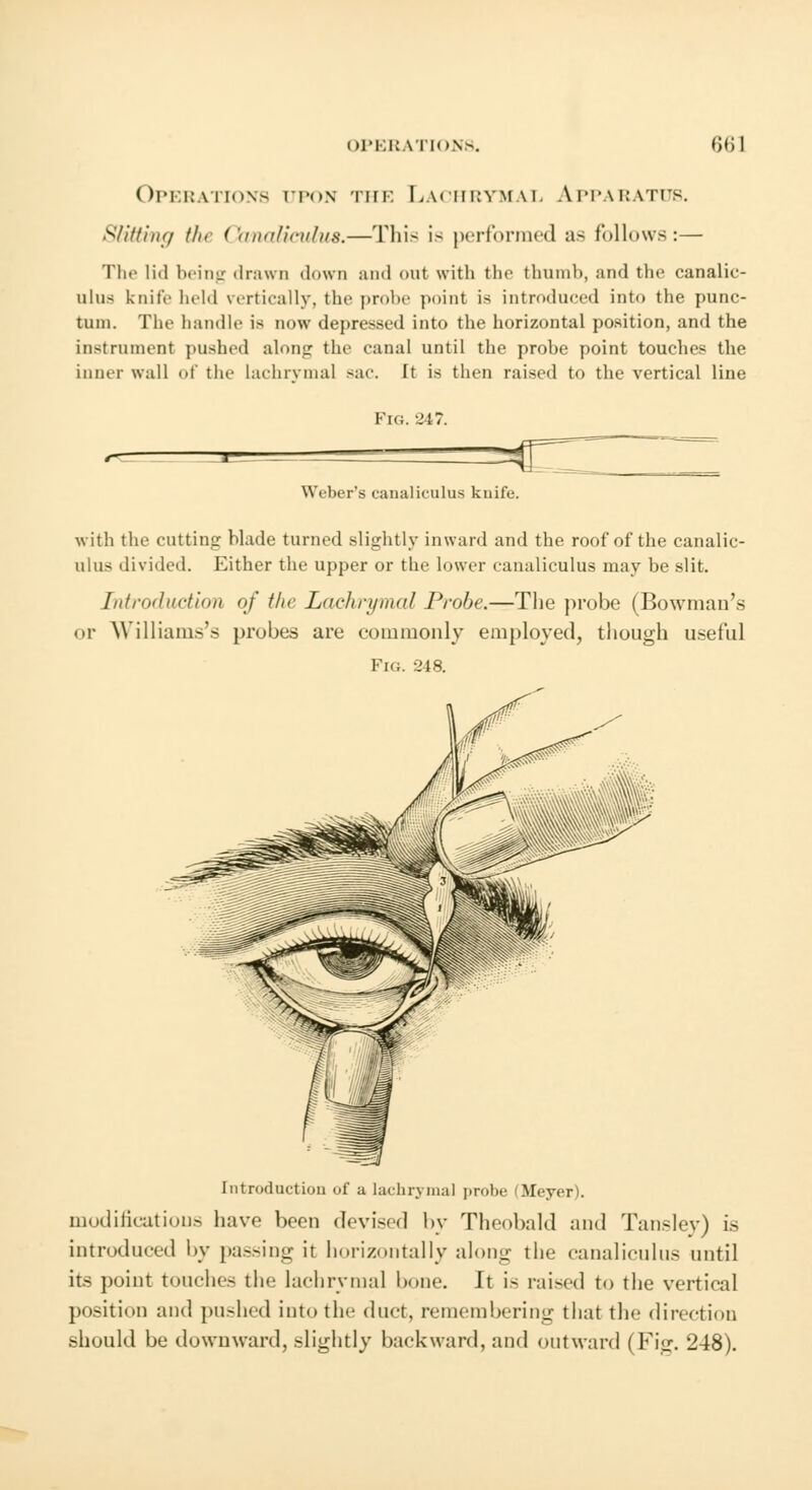 Operations upon the Lachrymal Apparatub. Slitting the Canaliculus.—This is performed as follows:— The li<l being drawn down and out with the thumb, and the canalic- ulus knife held vertically, the probe point ia introduced into the punc- tuni. The handle is now depressed into the horizontal position, and the instrument pushed along the canal until the probe point touches the inner wall of the lachrymal sac. It is then raised to the vertical line Fig. 247. Weber's canaliculus knife. with the cutting blade turned slightly inward and the roof of the canalic- ulus divided. Either the upper or the lower canaliculus may be slit. Introduction of the Lachrymal Probe.—The probe (Bowman's or Williams's probes are commonly employed, though useful Pig. 248. Introduction of a lachrymal probe (Meyer). modifications have been devised by Theobald and Tanslev) is introduced by passing it horizontally along the canaliculus until its point touches the lachrymal bone. It is raised to the vertical position and pushed into the duct, remembering that the direction should be downward, slightly backward, and outward ( Fig. 248).