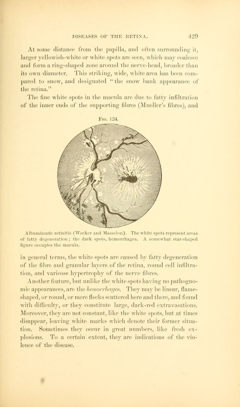 At sonic distance from the papilla, and often surrounding it, larger yellowish-white or white spots are seen, which may coalesce and form a ring-shaped zone around the nerve-head, broader than its own diameter. This striking, wide, white area has been com- pared to snow, and designated the snow bank appearance of the retina. 'The fine white spots in the macula are due to fatty infiltration of the inner ends of the supporting fibres (Mueller's fibres), and Fig. 124. Albuminuric retinitis (Wecker and Massclou). The white spots represent areas of fatty defeneration ; the dark spots, hemorrhages. A somewhat star-shaped figure occupies the macula. in general terms, the white spots are caused by fatty degeneration of the fibre and granular layers of the retina, round cell infiltra- tion, and varicose hypertrophy of the nerve fibres. Another feature, but unlike the white spots having no pathogno- mic appearances, are the hemoi*rhages. They may be linear, flame- shaped, or round, or mere flecks scattered here and there, and found with difficulty, or they constitute large, dark-red extravasations. Moreover, they are not constant, like the white spots, but at times disappear, leaving white marks which denote their former situa- tion. Sometimes they occur in great numbers, like fresh ex- plosions. To a certain extent, they are indications of the vio- lence of the disease.