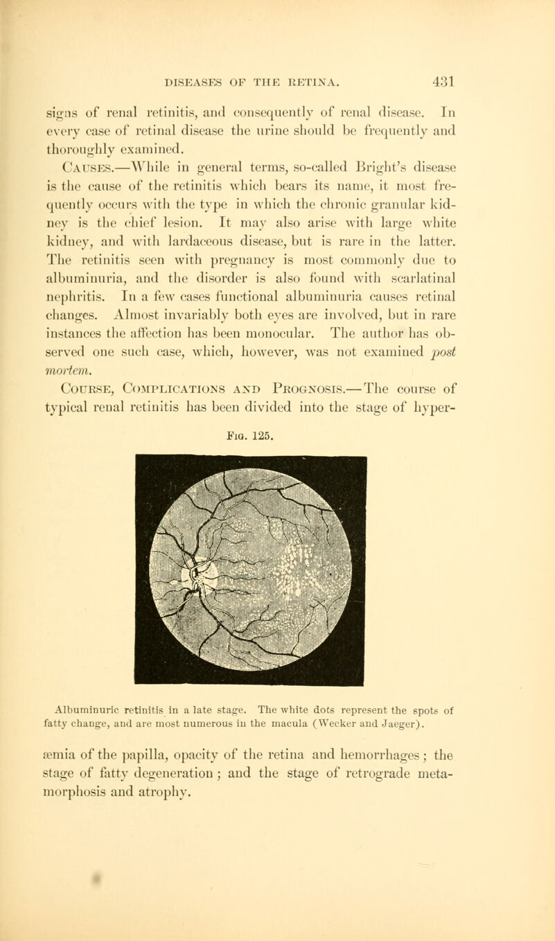 signs of renal retinitis, and consequently of renal disease. Tn every ease of retinal disease the urine should be frequently and thoroughly examined. Causes.—While in general terras, so-called Kright's disease is the cause of the retinitis which bears its name, it most fre- quently occurs with the type in which the chronic granular kid- ney is the chief lesion. It may also arise with large white kidney, and with lardaceous disease, but is rare in the latter. The retinitis seen with pregnancy is most commonly due to albuminuria, and the disorder is also found with scarlatinal nephritis. In a few cases functional albuminuria causes retinal changes. Almost invariably both eyes are involved, but in rare instances the affection has been monocular. The author has ob- served one such case, which, however, was not examined post mortem. Course, Complications and Prognosis.—The course of typical renal retinitis has been divided into the stage of hyper- Fiq. 125. Albuminuric retinitis in a late stage. The white dots represent the spots of fatty change, and are most numerous in the macula (Wecker and Jaeger). araiia of the papilla, opacity of the retina and hemorrhages; the stage of fatty degeneration ; and the stage of retrograde meta- morphosis and atrophy.