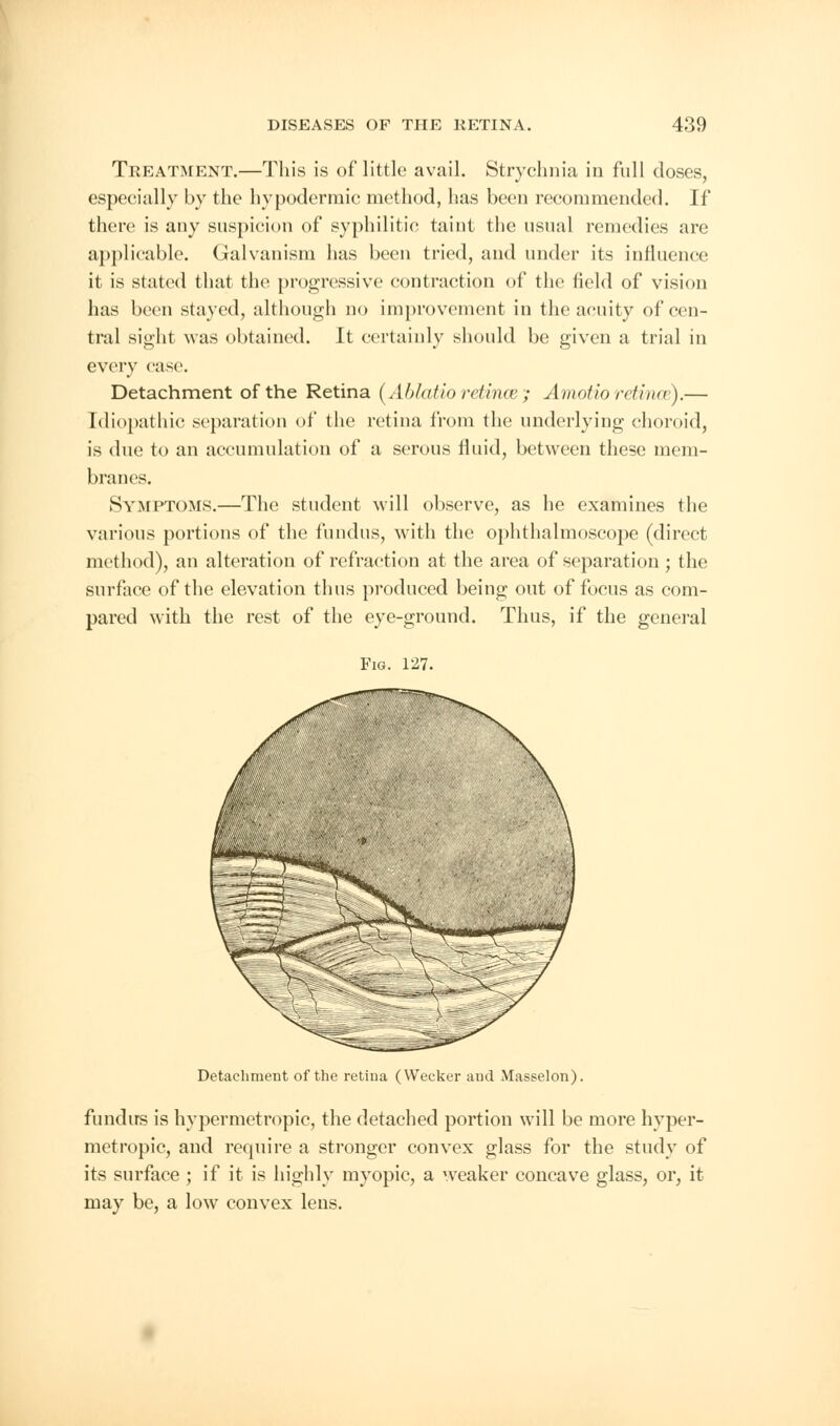 Treatment.—This is of little avail. Strychnia in full doses, especially by the hypodermic method, has been recommended. If there is any suspicion of syphilitic taint the usual remedies are applicable. Galvanism has been tried, and under its inlluence it is stated that the progressive contraction of the held of vision has been stayed, although no improvement in the acuity of cen- tral sight was obtained. It certainly should be given a trial in every case. Detachment of the Retina (Ablatio retince'; Amotio refine).— Idiopathic separation of the retina from the underlying choroid, is due to an accumulation of a serous fluid, between these mem- branes. Symptoms.—The student will observe, as he examines the various portions of the fundus, with the ophthalmoscope (direct method), an alteration of refraction at the area of separation ; the surface of the elevation thus produced being out of focus as com- pared with the rest of the eye-ground. Thus, if the general Fig. 127. Detachment of the retina (Wecker aud Masselon). fundus is hypermetropic, the detached portion will be more hyper- metropic, and require a stronger convex glass for the study of its surface ; if it is highly myopic, a weaker concave glass, or, it may be, a low convex lens.