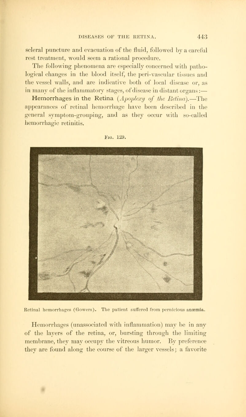 scleral puncture and evacuation of the fluid, followed by a careful rest treatment, would seem a rational procedure. The following phenomena are especially concerned with patho- logical changes in the blood itself, the peri-vascular tissues and the vessel walls, and are indicative both of local disease or, as in many of the inflammatory stages, of disease in distant organs:— Hemorrhages in the Retina {Apoplexy of the Retina).—The appearances of retinal hemorrhage have been described in the general symptom-grouping, and as they occur with so-called hemorrhagic retinitis. Fig. 129. Retinal hemorrhages (Gowers). The patient suffered from pernicious anaemia. Hemorrhages (unassociated with inflammation) may be in any of the layers of the retina, or, bursting through the limiting membrane, they may occupy the vitreous humor. By preference they are found along the course of the larger vessels; a favorite