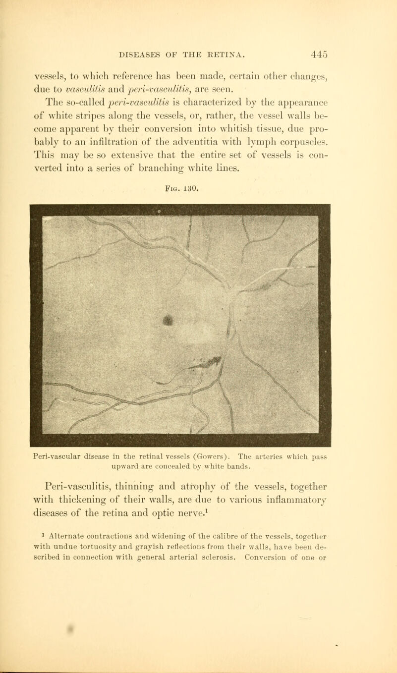 vessels, to which reference has been made, certain other changes, due to vasculitis and peri-vasculitis, arc seen. The so-called peri-vasculitis is characterized by the appearance of white stripes along the vessels, or, rather, the vessel walls be- come apparent by their conversion into whitish tissue, due pro- bably to an infiltration of the adventitia with lymph corpuscles. This may be so extensive that the entire set of vessels is eon- verted into a series of branching white lines. Fig. 130. Peri-vascular disease in the retinal vessels (Gowers). The arteries which pass upward are concealed by white bands. Peri-vasculitis, thinning and atrophy of the vessels, together with thickening of their walls, are due to various inflammatory diseases of the retina and optic nerve.1 1 Alternate contractions and widening of the calibre of the vessels, together with undue tortuosity and grayish reflections from their walls, have beeu de- scribed in connection with general arterial sclerosis. Conversion of one or