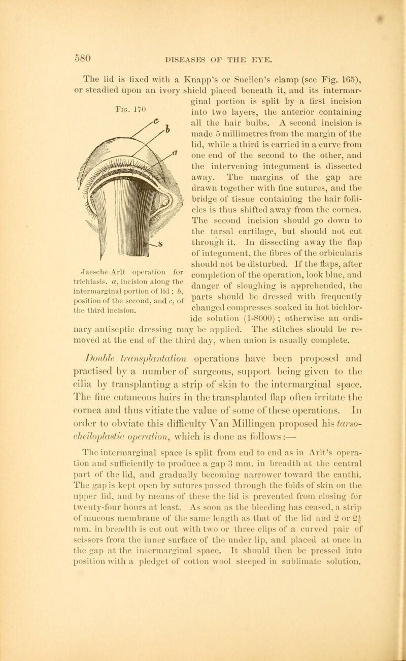 Fig. 170 Jaesche-Arlt operation for trichiasis, a, incision along the intermarginal portion of lid ; ft. position of the second, and c, of the third incision. The lid is fixed with a Knapp's or Snellen's clamp (see Fig. 165), or steadied upon an ivory shield placed heneath it, and its intermar- ginal portion is split by a first incision into two layers, the anterior containing all the hair bulbs. A second incision is made 5 millimetres from the margin of the lid, while a third is carried in a curve from one end of the second to the other, and the intervening integument is dissected away. The margins of the gap are drawn together with fine sutures, and the bridge of tissue containing the hair folli- cles is thus shifted away from the cornea. The second incision should go down to the tarsal cartilage, but should not cut through it. In dissecting away the flap of integument, the fibres of the orbicularis should not be disturbed. If the flaps, after completion of the operation, look blue, and danger of sloughing is apprehended, the parts should be dressed with frequently changed compresses soaked in hot bichlor- ide solution (1-8000) ; otherwise an ordi- nary antiseptic dressing may be applied. The stitches should be re- moved at the end of the third day, when union is usually complete. Double, transplantation operations have been proposed and practised by a number of surgeons, support being given to the cilia bv transplanting a strip of skin to the intermarginal space. The fine cutaneous hairs in the transplanted flap often irritate the cornea and thus vitiate the value of some of these operations. In order to obviate this difficulty Van Millingen proposed his tarso- cheiloplastic operation, which is done as follows:— The intermarginal space is split from end to end as in Arlt's opera- tion and sufficiently to produce a gap 8 mm. in breadth at the central part of the lid, and gradually becoming narrower toward the canthi. The gap is kept open by sutures passed through the folds of skin on the upper lid, and by means of these the lid is prevented from closing for twenty-four hours at least. As soon as the bleeding has ceased, a strip of mucous membrane of the same length as that of the lid ami l' or '_, mm. in breadth is cut out with two or three clips of a curved pair of scissors from the inner surface of the under lip, and placed at once in the gap at the intermarginal space. It should then he pressed into position with a pledget of cotton wool steeped in sublimate solution.