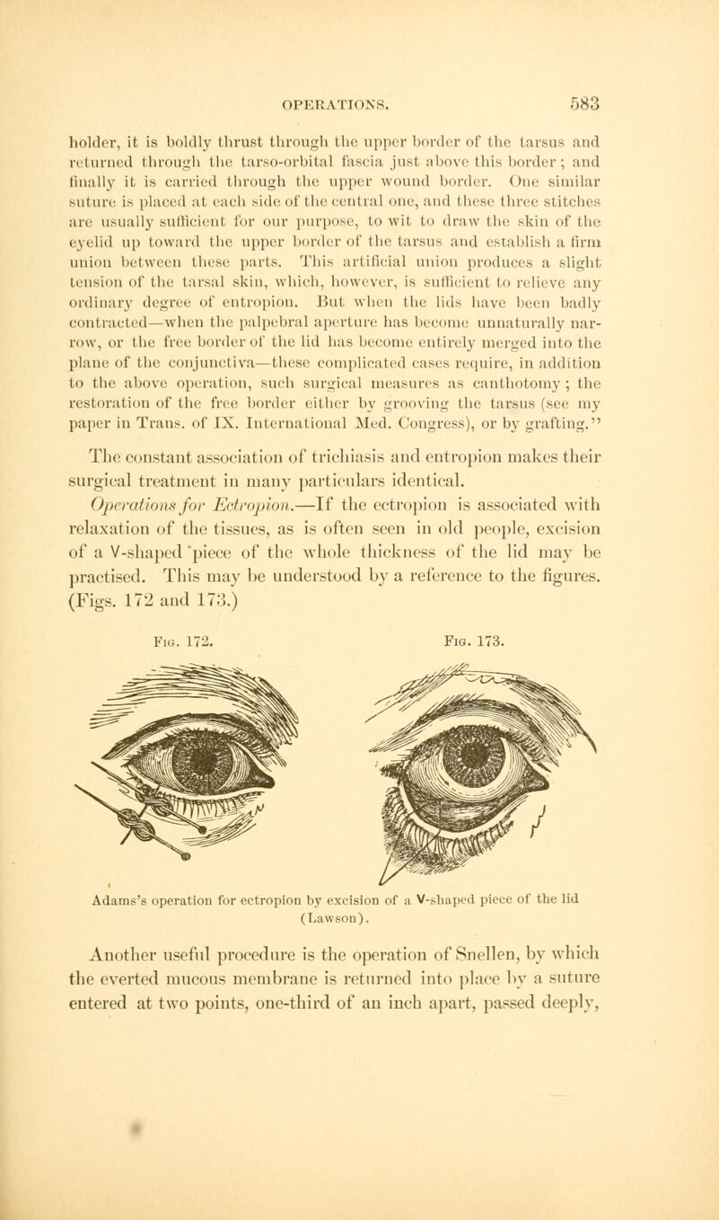 holder, it is boldly thrust through the upper border of the tarsus and returned through the tarso-orbital fascia just above this border; and linally it is carried through the upper wound border. One similar suture is placed ;it each side of the central one, and these three stitches are usually sufficient for our purpose, to wit to draw the skin of the eyelid up toward the upper border of the tarsus and establish a firm union between these parts. This artificial union produces a slight tension of the tarsal skin, which, however, is sufficient to relieve any ordinary degree of entropion. But when the lids have been badly contracted—when the palpebral aperture has become unnaturally nar- row, or the free border of the lid has become entirely merged into the plane of the conjunctiva—these complicated cases require, in addition to the above operation, such surgical measures as canthotomy ; the restoration of the free border either by grooving the tarsus (see my paper in Trans, of IX. International Med. Congress), or by grafting. The constant association of trichiasis and entropion makes their surgical treatment in many particulars identical. Operations for Ectropion.—If the ectropion is associated with relaxation of the tissues, as is often seen in old people, excision of a V-shaped piece of the whole thickness of the lid may be practised. This may be understood by a reference to the figures. (Figs. 172 and 17;).') Fig. 172. Fig. 173. Adams's operation for ectropion by excision of a V-shaped piece of the lid (Law son). Another useful procedure is the operation of Snellen, by which the everted mucous membrane is returned into place by a suture entered at two points, one-third of an inch apart, passed deeply,