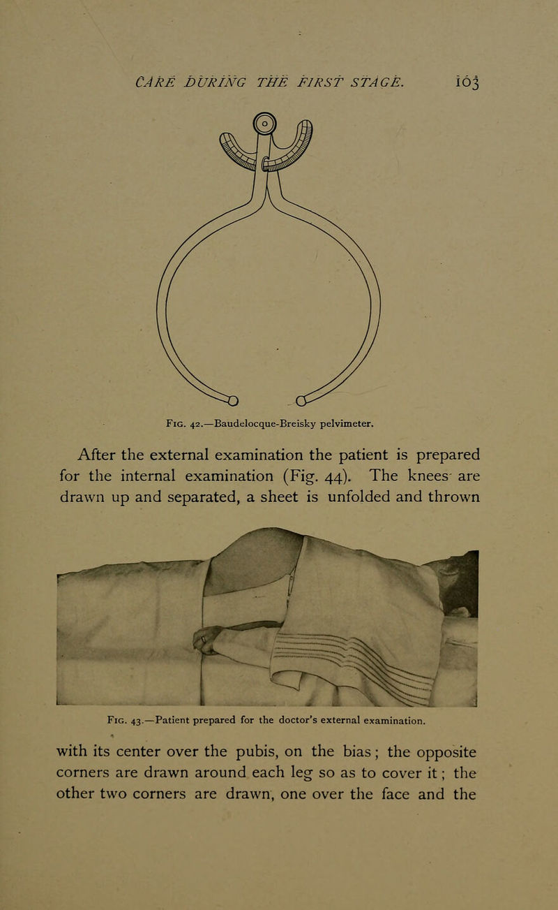 -Baudelocque-Breisky pelvimeter. After the external examination the patient is prepared for the internal examination (Fig. 44). The knees- are drawn up and separated, a sheet is unfolded and thrown Fig. 43.—Patient prepared for the doctor's external with its center over the pubis, on the bias; the opposite corners are drawn around each leg so as to cover it; the other two corners are drawn, one over the face and the