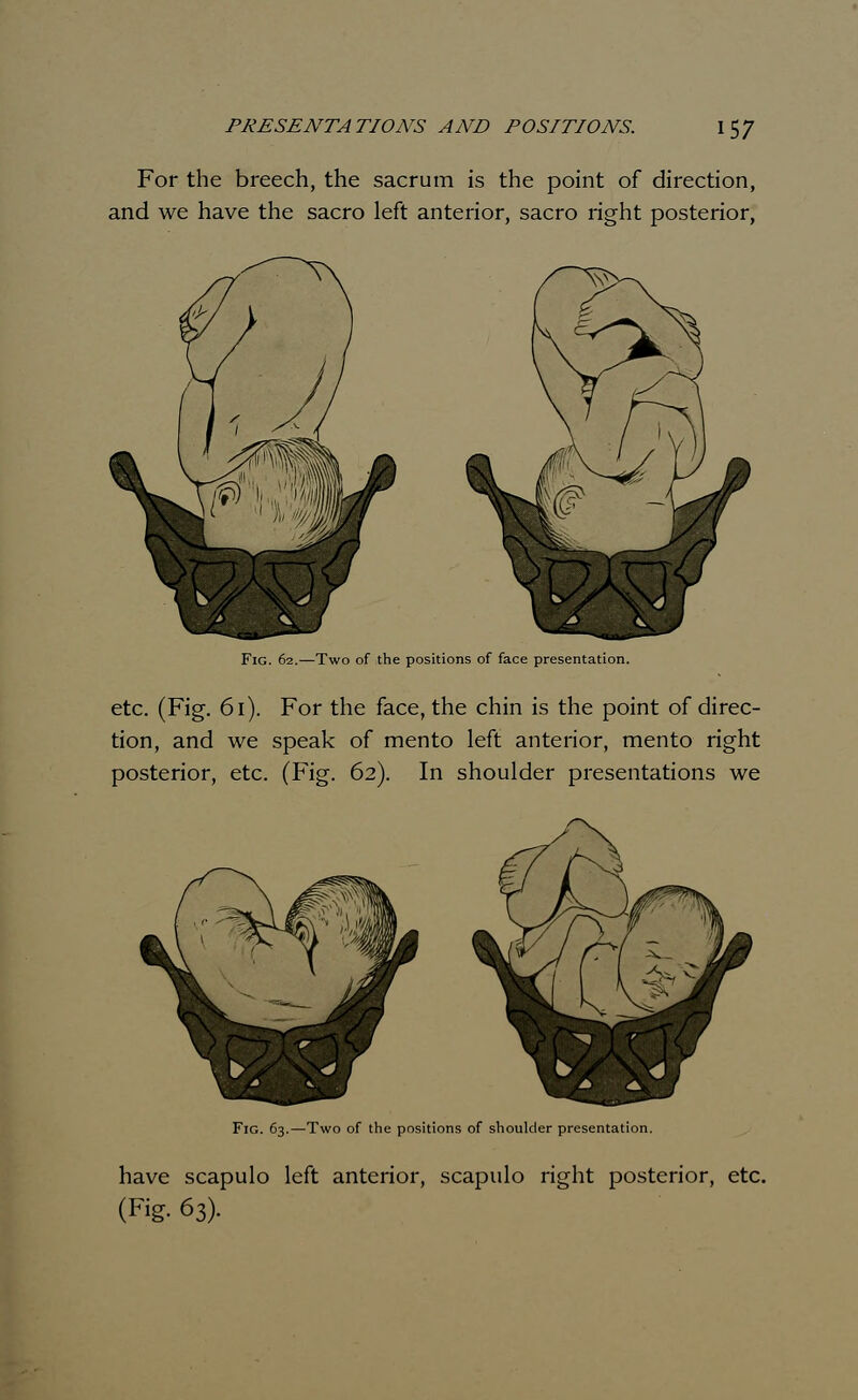 For the breech, the sacrum is the point of direction, and we have the sacro left anterior, sacro right posterior, Fig. 62.—Two of the positions of face presentation. etc. (Fig. 61). For the face, the chin is the point of direc- tion, and we speak of mento left anterior, mento right posterior, etc. (Fig. 62). In shoulder presentations we Fig. 63.—Two of the positions of shoulder presentation. have scapulo left anterior, scapulo right posterior, etc. (Fig. 63).