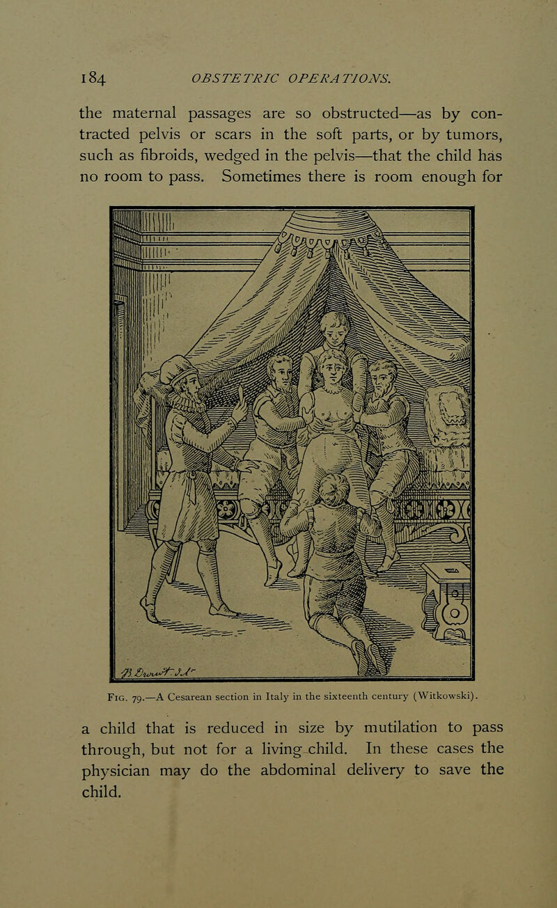 the maternal passages are so obstructed—as by con- tracted pelvis or scars in the soft parts, or by tumors, such as fibroids, wedged in the pelvis—that the child has no room to pass. Sometimes there is room enough for Fig. 79.—A Cesarean section in Italy in the sixteenth century (Witkowski). a child that is reduced in size by mutilation to pass through, but not for a living .child. In these cases the physician may do the abdominal delivery to save the child.