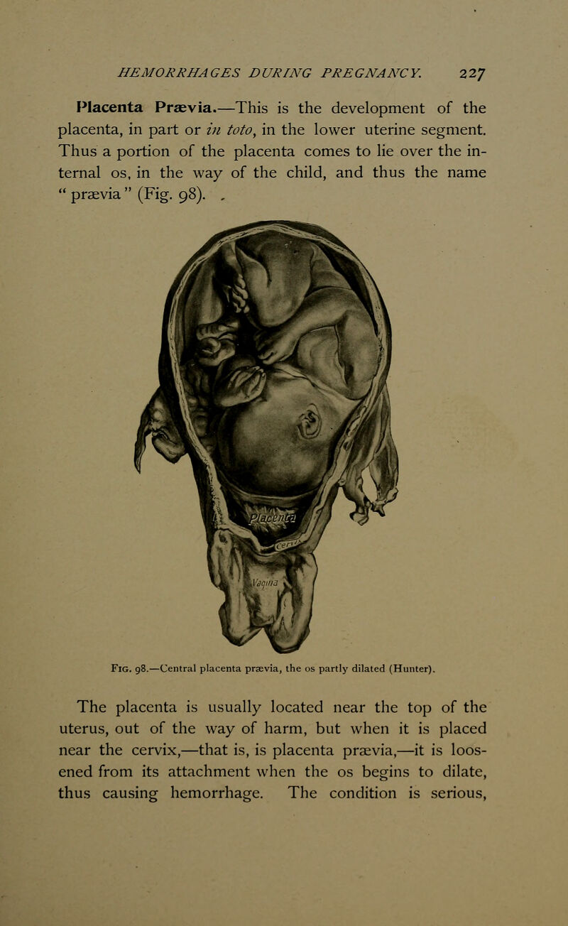 Placenta Praevia.—This is the development of the placenta, in part or in toto, in the lower uterine segment. Thus a portion of the placenta comes to lie over the in- ternal os, in the way of the child, and thus the name  praevia  (Fig. 98). , Fig. 98.—Central placenta praevia, the os partly dilated (Hunter). The placenta is usually located near the top of the uterus, out of the way of harm, but when it is placed near the cervix,—that is, is placenta praevia,—it is loos- ened from its attachment when the os begins to dilate, thus causing hemorrhage. The condition is serious,